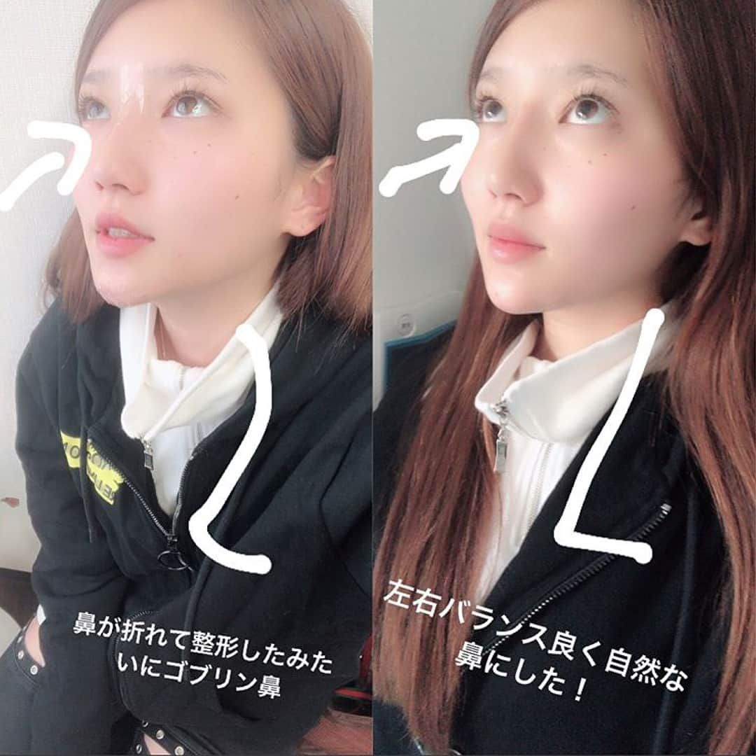 恵比寿フィラークリニックさんのインスタグラム写真 - (恵比寿フィラークリニックInstagram)「緒方友莉奈さん、いつもありがとうございます🌹✨✨ . ヒアルロン酸注入は、左右差の解消も可能🙆もちろんボトックスや脂肪溶解注射も同様です。カウンセリングにてご相談ください！ . . #メイク感覚で楽しむフィラー  #すっぴんで勝てる #フィラークリニック  #フィラー #fillerclinic . . いつも、整形したとかゴブリン言われた鼻をナチュラルに左右バランス良くしてもらいました😭 私整形顔嫌いだから天海祐希さんや吉瀬美智子さんみたいにナチュラル美人になりたいから矯正してもらいました！ @filler_clinic  化粧したらまたアップします⤴️ #メンテナンス #美容好きな人と繋がりたい  #筋肉女子  #高身長女子  #ゆるふわ  #オルチャン #オルチャンメイク #オルチャンファッション  #漂亮  #謝謝 #ㅋㅋㅋ #도쿄 #안녕 #얼짱 #얼짱아기  #艶髪  #セクシー #ボディメイク  #トレーニング #筋トレ #筋トレ女子  #今日のメイク」3月29日 19時32分 - filler_clinic