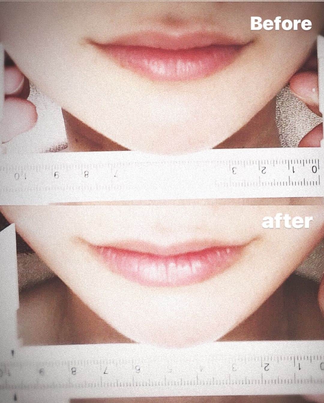 呉屋ありささんのインスタグラム写真 - (呉屋ありさInstagram)「. . 私の小顔の秘訣はコレ♡笑 . 私は歯を食いしばる癖があり エラが張るんです。 @bodymaketranji さんで 骨格調整してリンパで流した後に魔法のクリーム♡ . ▶︎DETODAMA FACE #デトダーマフェイス でさらに整えるとなんと、いつも1.5センチほどシャープになります:(；ﾞﾟ'ωﾟ'): . 私は女性を見るときは必ずフェイスラインに目がいく。フェイスラインのたるみは老けみえる。女はラインが命‼︎ . アゴアゴアゴー‼︎ . 私はデトダーマで朝晩ホームケア♡ . 顔の骨格などに悩んでいるならぜひ試してみてね♡魔法のクリームも販売してるよん . #bodymake #beauty#faceup#小顔#美容#骨格悩み#神の手#ビフォーアフター#デトダーマ#リフトアップ#顔の脂肪#半端ない#アフター宇宙人#女はフェイスライン#綺麗になる#サイズダウン」3月7日 23時18分 - arisa_goya