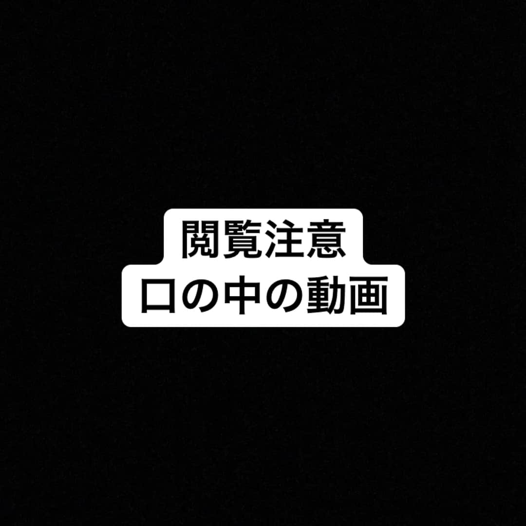 ファーストサマーウイカさんのインスタグラム写真 - (ファーストサマーウイカInstagram)「オーソシルというワックス(練り消しみたい)を矯正器具につけると、口内炎防止、痛みの緩和、滑舌悪化の補助ができる。 お仕事の前はいつもこれを器具につけます。 #矯正女子  #裏側矯正  #ウイカ裏側矯正記録」3月23日 23時55分 - f_s_uika