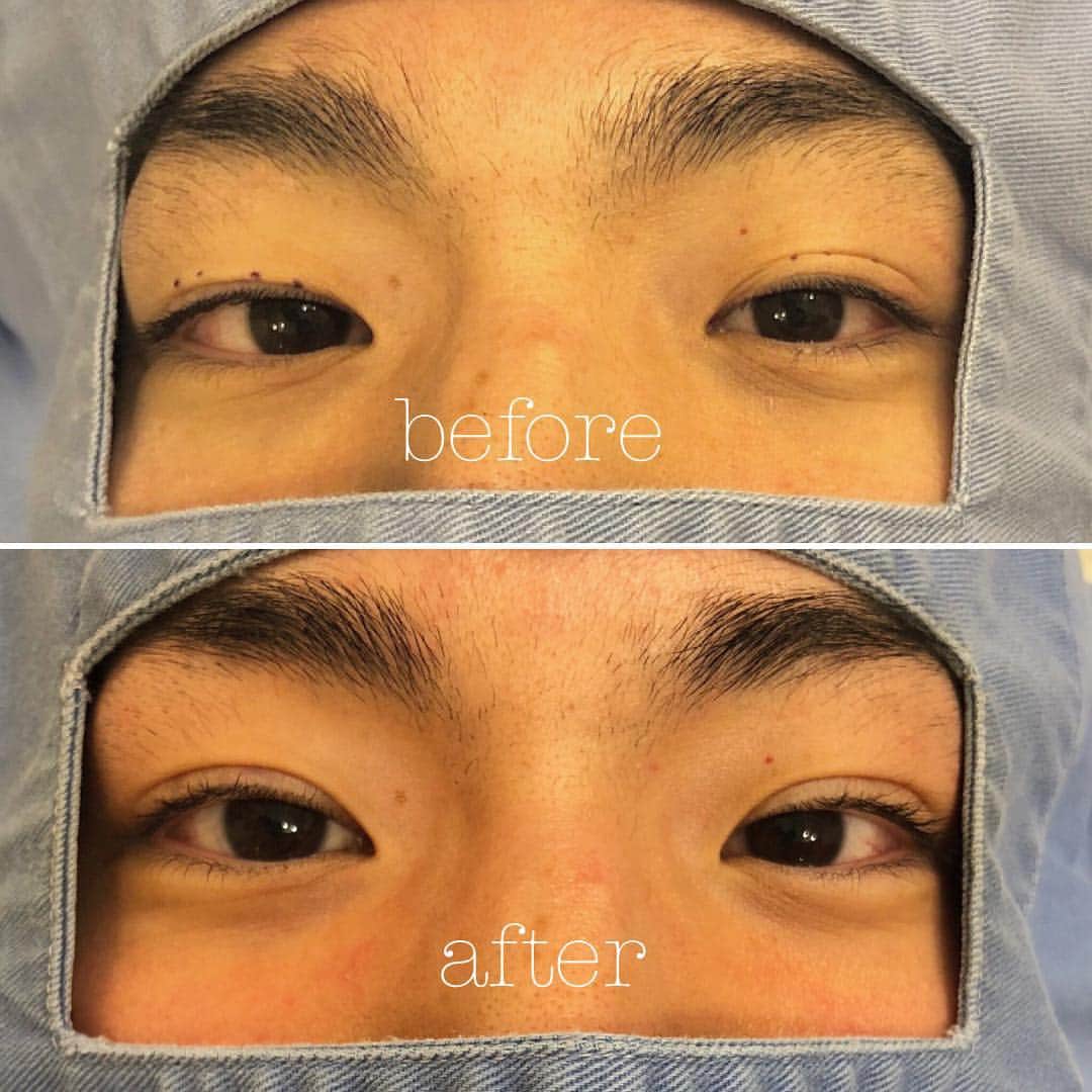 東京イセアクリニックさんのインスタグラム写真 - (東京イセアクリニックInstagram)「👀 切らずに二重 👨🏻‍⚕️✨ . 埋没法で、二重幅の左右差がなくなりまし🌟 写真下:after 1ヶ月 .  1週間程度である程度の腫れは引きますが... 腫れや内出血には個人差があります💉 必ずしも.ダウンタイムがゼロではありません😖💦 . . 満足頂けるように.当院では保証をご用意しております👨🏻‍⚕️✨ . 美容クリニックにご来院頂く男性は増えています👱🏻‍♂️💕 . カウンセリングは無料ですので お気軽にお問い合わせ下さい💁🏼‍♀️💁🏼‍♂️ . #銀座#ginza  #iseaclinic#イセアクリニック #美容整形#美容外科#美容皮膚科 #吉種克之 #美容#整形#プチ整形 #アイプチ#アイテープ#二重#埋没#埋没法 #全切開#デカ目#修正#切らない#モニター募集  #綺麗になりたい#可愛くなりたい」4月23日 18時19分 - iseaclinic