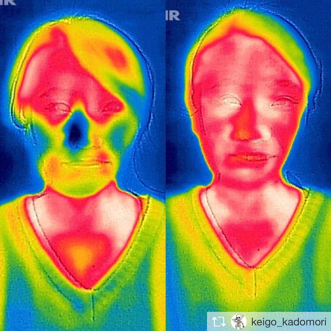 角森脩平さんのインスタグラム写真 - (角森脩平Instagram)「. #KADOMORI#カリスマ#スタッフ @keigo_kadomori . 小顔矯正と頭蓋骨矯正による体温の変化をサーモグラフィーで検証しました‼️‼️ ・ 体の冷えは自覚しやすいですが、顔の冷えは案外気づいてない方が多いです💦 ・ 冷えが続くと脂肪もつきやすくなってプニプニしたお顔になってしまいます😅😭😱 ・ 骨格の歪みを整えていくと神経、筋肉、脂肪、皮膚、全ての伝達がスムーズになって結果的に血流の改善による体温UP⬆︎⬆︎が実現します☺️ ・ ・ 一回でもしっかり効果は出るし最低3回〜5回施術をすると比較的良好な状態でキープしていきます🎶 ・ ・ 健康的で可愛いお顔になりたい方はご一報下さい👍 DMやコメントお待ちしてますね✨ ・ @kadomori_kogao  #カドモリ #頭蓋骨矯正 #小顔矯正 #検証 #研究 #美人 #可愛い #モテ顔 #黄金比 #美容 #唯一の技術 #自信#シンクロウェーブ #synchrowave」4月20日 21時40分 - kadomori570731