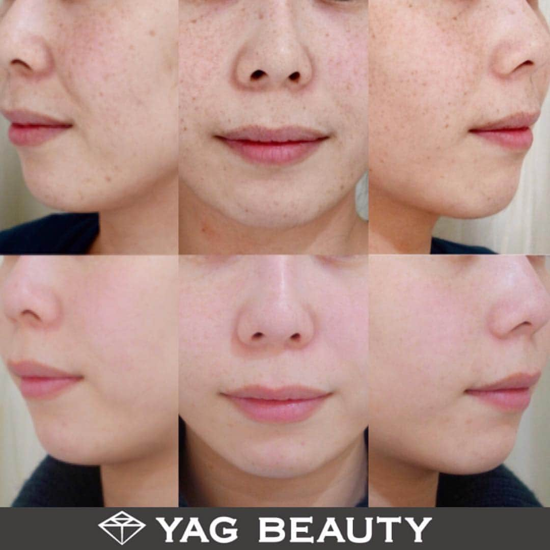 YAG BEAUTY CLINICさんのインスタグラム写真 - (YAG BEAUTY CLINICInstagram)「. 仙台院のモニター様のご紹介です❁ 〈シミ・そばかす〉 上:治療前  下:レーザートーニング17回照射＋スポット照射後 . 気になるシミ・そばかすも、回数を重ねることで、結果は付いてきます。 改善とともに美白効果も★ . YAG BEAUTY 仙台院 (The Beauty Clinic 内) JR仙台駅西口より徒歩2分 📞0120073888 . . 🔷施術名：レーザートーニング+スポット照射 🔶施術の説明：メラニン吸収の特性を持った波長を使用して肝斑を含む各種のくすみなど皮膚表面の色調を改善する治療です。 🔷施術の価格：全顔パック付き1回 9,000円(税別)×15回 スポット照射全顔取り放題100,000円(税別) 💰235,000円(税別) 🔶目安時間：5分〜20分程度 . 🔷施術の副作用（リスク）：発赤、熱感、痒み、痛み、乾燥が生じます。 ※施術内容の詳細はコメント欄に記載有。 . .  #YAGBEAUTY #thebeautyclinic #仙台」5月22日 16時02分 - yagbeauty_official