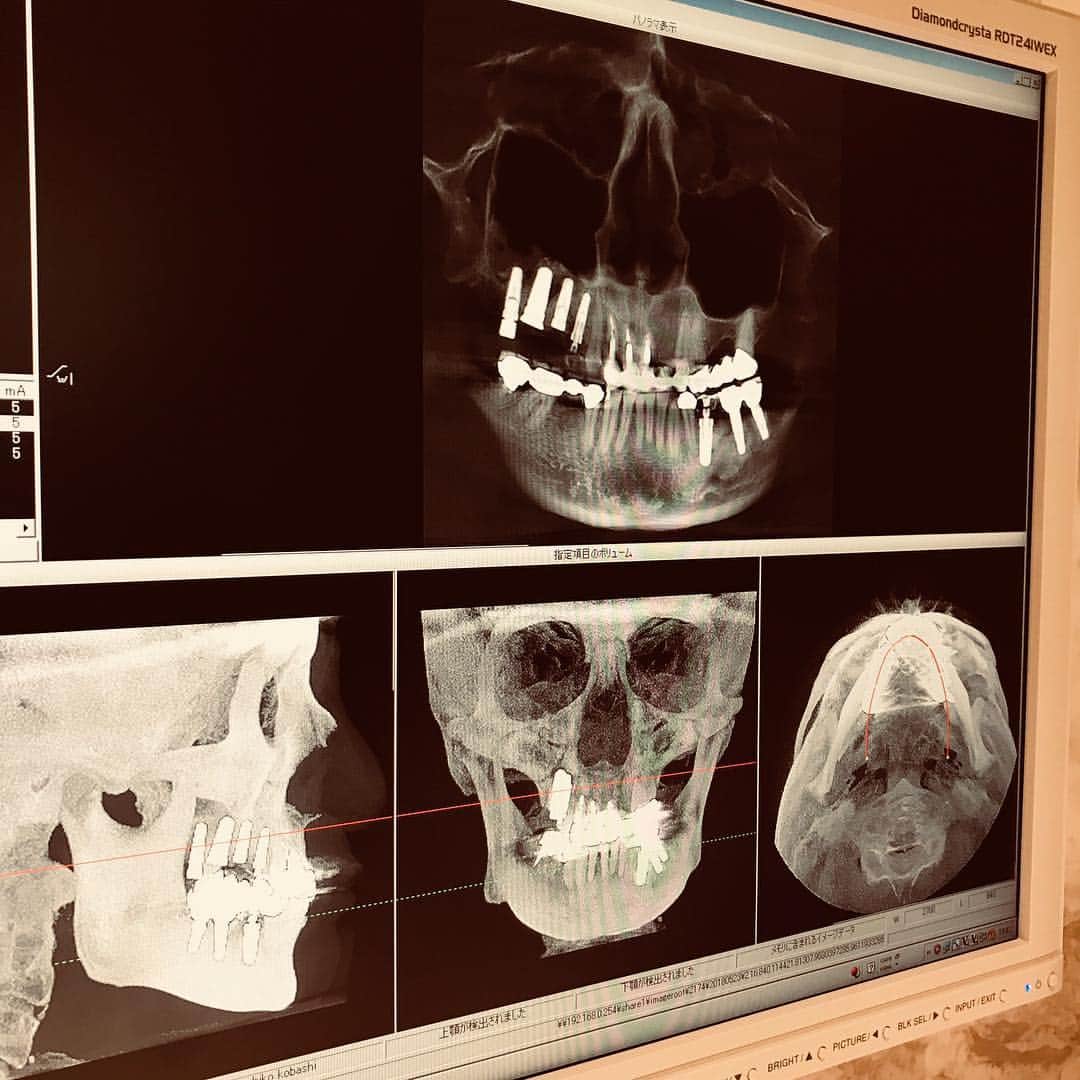 TERUさんのインスタグラム写真 - (TERUInstagram)「二本抜歯してそのまま二本インプラントを入れると言う高度な技術。  もう２０ねんの付き合いになります、主治医のタバッチ先生。  この先人生９０歳まで健康に生きるぞ！と計画を立てて、健康であるには歯が大事！という事で、昨年から集中して歯の治療をしてきてますが、この半年ですでに５本のインプラントを入れました。  １日６時間かけて休みなく治療した日もありました。  スタッフの方々の熱意に感謝。  そしてタバッチ先生に感謝。  一生付き合ってくれて、信頼できる先生に出会えて、本当に良かった。  まだまだ治療は続きますが、食欲旺盛なおじいちゃん目指して頑張ります^ - ^  #タバタクリニック」5月23日 15時02分 - glay__teru
