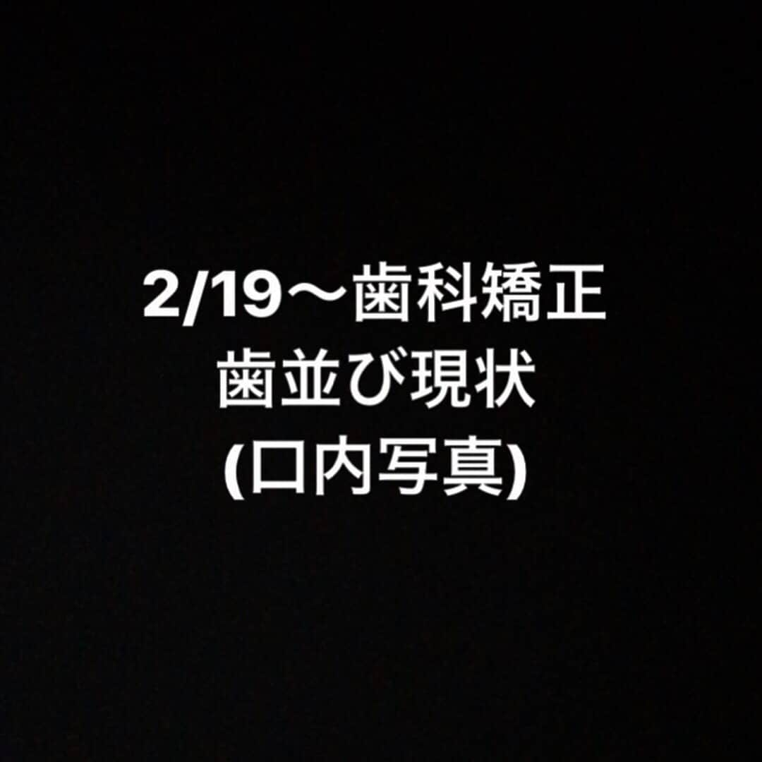 ファーストサマーウイカさんのインスタグラム写真 - (ファーストサマーウイカInstagram)「6/9 現在の 歯並び ・上の歯が全体的に前に出てきて、逆にすこし出っ歯な部分がある ・前後移動の激しかった下の歯が並ぶ！  かなり並んできた！！！ #ウイカ裏側矯正記録  #歯科矯正  #歯科矯正女子  #裏側矯正」6月9日 11時23分 - f_s_uika