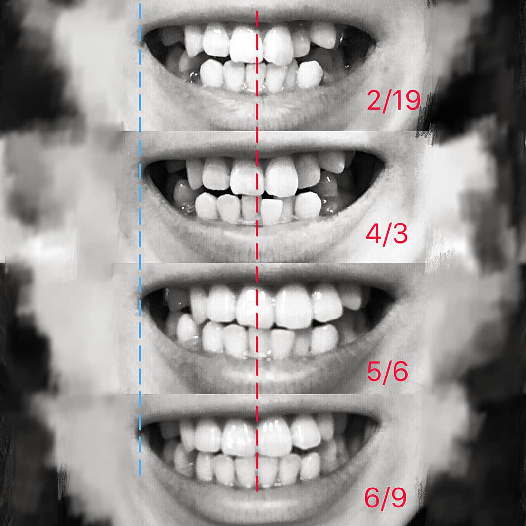 ファーストサマーウイカさんのインスタグラム写真 - (ファーストサマーウイカInstagram)「6/9 現在の 歯並び ・上の歯が全体的に前に出てきて、逆にすこし出っ歯な部分がある ・前後移動の激しかった下の歯が並ぶ！  かなり並んできた！！！ #ウイカ裏側矯正記録  #歯科矯正  #歯科矯正女子  #裏側矯正」6月9日 11時23分 - f_s_uika
