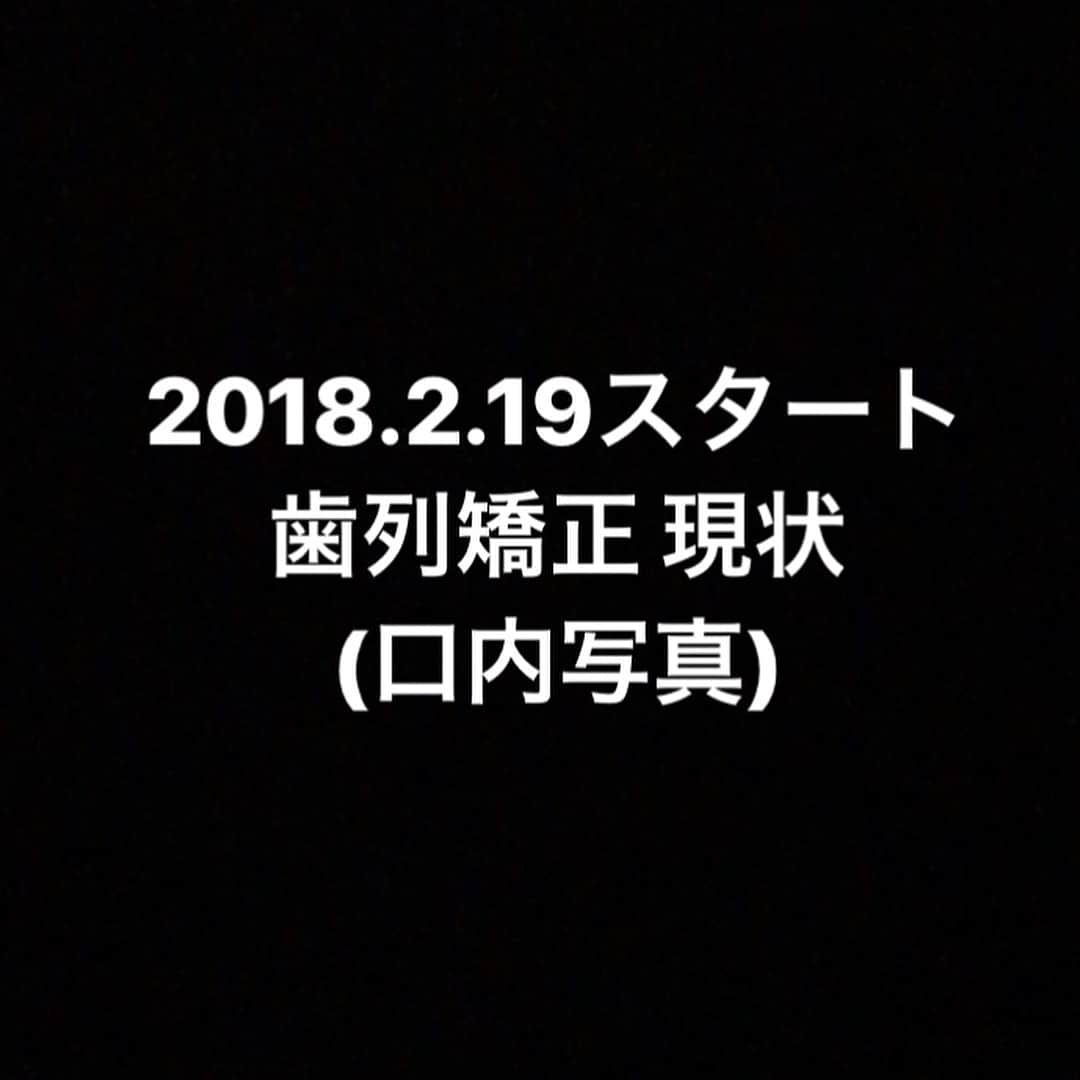 ファーストサマーウイカさんのインスタグラム写真 - (ファーストサマーウイカInstagram)「抜いた後ろの歯がかなり動いて来ました。 センターがまた少しズレました。 行ったり来たり繰り返しますね。  確実に綺麗になっています。 #ウイカ裏側矯正記録  #裏側矯正  #矯正女子」7月25日 22時05分 - f_s_uika