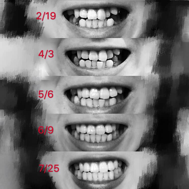 ファーストサマーウイカさんのインスタグラム写真 - (ファーストサマーウイカInstagram)「抜いた後ろの歯がかなり動いて来ました。 センターがまた少しズレました。 行ったり来たり繰り返しますね。  確実に綺麗になっています。 #ウイカ裏側矯正記録  #裏側矯正  #矯正女子」7月25日 22時05分 - f_s_uika