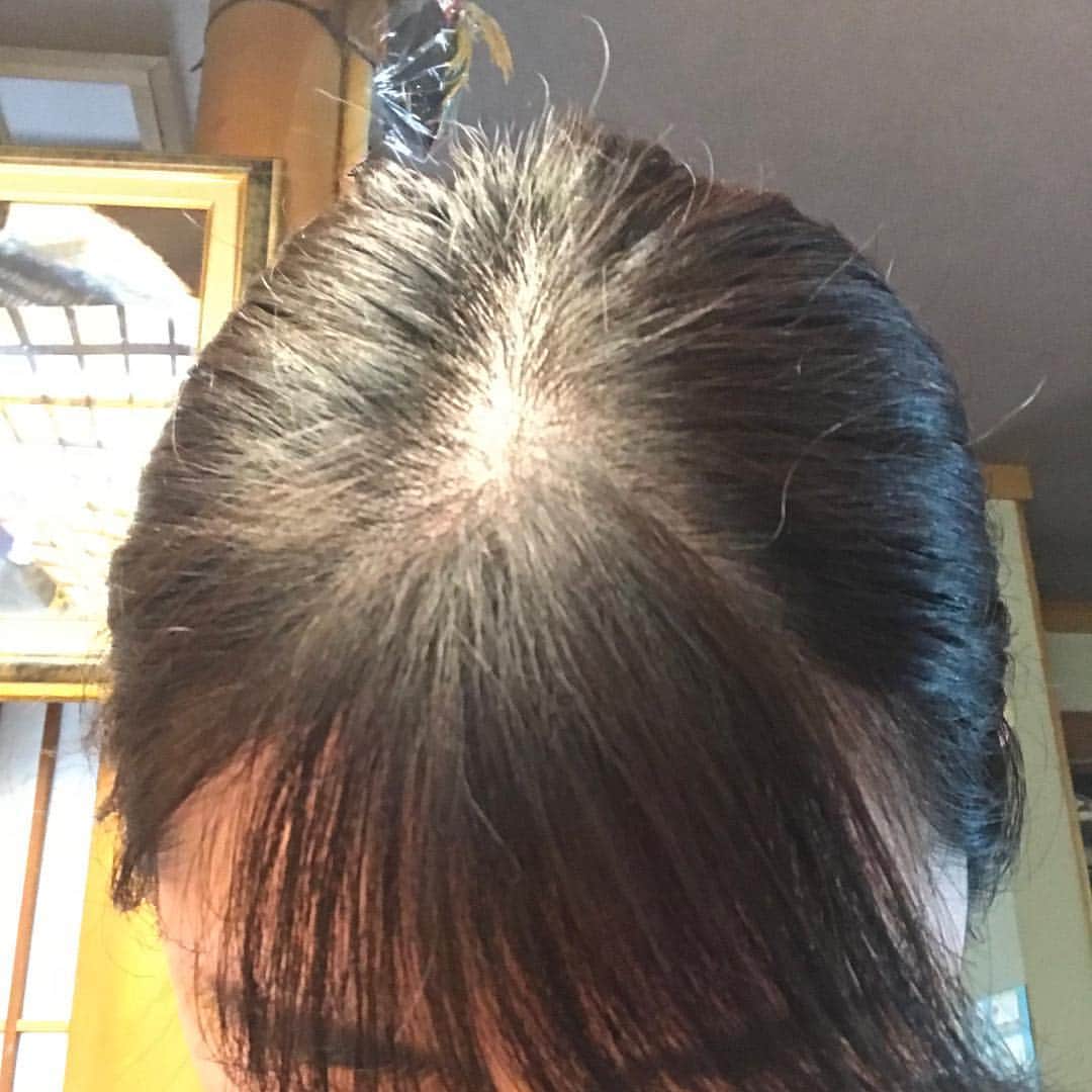 岡村咲さんのインスタグラム写真 - (岡村咲Instagram)「最近、短い毛がぴょんぴょん生えてきましたー🤩1枚目が最近、2枚目は酷かった2、3ヶ月前とかですかね？凄く嬉しいです💓#脱毛 #プラケニル 様々 #生えてきた」10月15日 11時02分 - sakiokamura_official