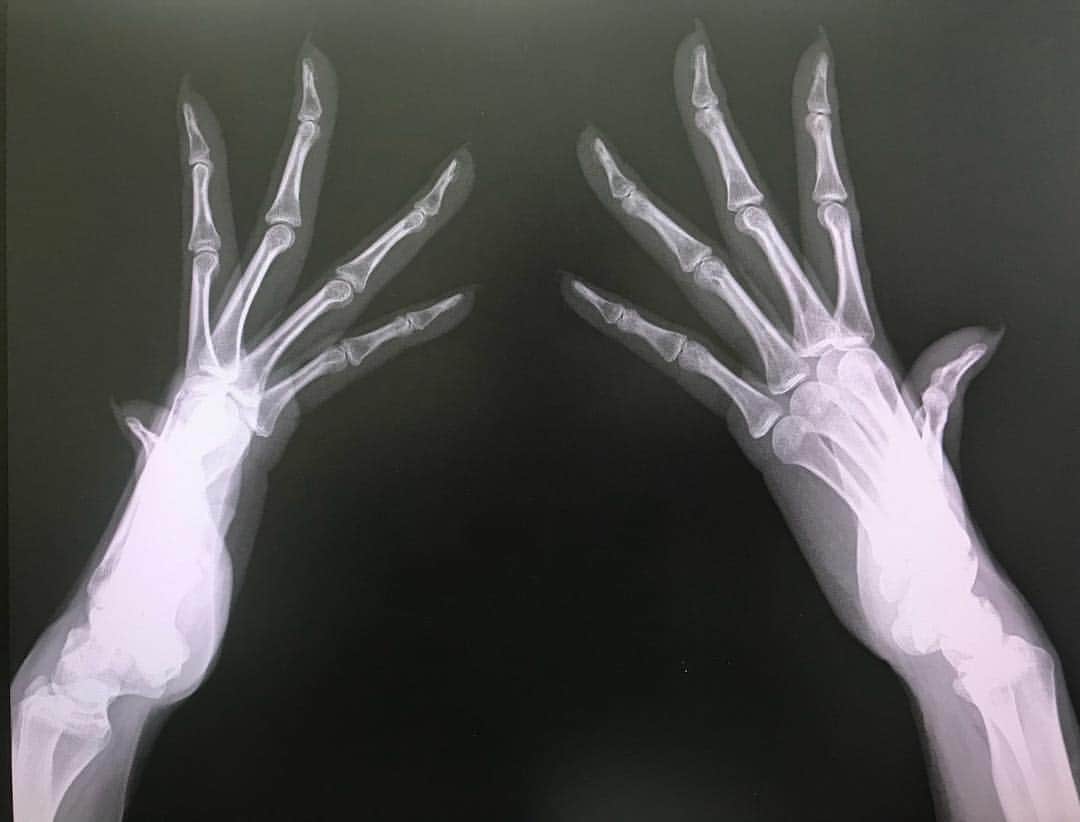 金子エミさんのインスタグラム写真 - (金子エミInstagram)「今まで手の写真はたくさん撮ってもらいましたが、手の骨の写真は初めてです。 ☆ ☆横から全ての関節が見えるようにして！と言われ…あ、それは得意。と思いながら、骨の撮影は初めてだな。って。  一年前から小指の関節が痛くなり…今では殆どの関節か痛くなっており、変形性関節炎で指の関節が曲がってしまったら困る。と…今日 初めて整形外科を受診しました。レントゲン撮影の結果では、今のところ変形はなく、軟骨も正常とのこと。更年期が原因で手の関節が痛くなる事があるそうです。念のために膠原病、関節リウマチの血液検査も行いました。手を酷使し過ぎも考えられる。とも先生に言われ、手タレになってから26年。酷使したとも考えられるのかもしれないなあ。とにかく手だけの関節が痛いって…手だけはやめてほしいなあ🙏 #パーツモデル #手タレ #金子エミ #手のレントゲン」10月9日 16時38分 - emikaneko1114
