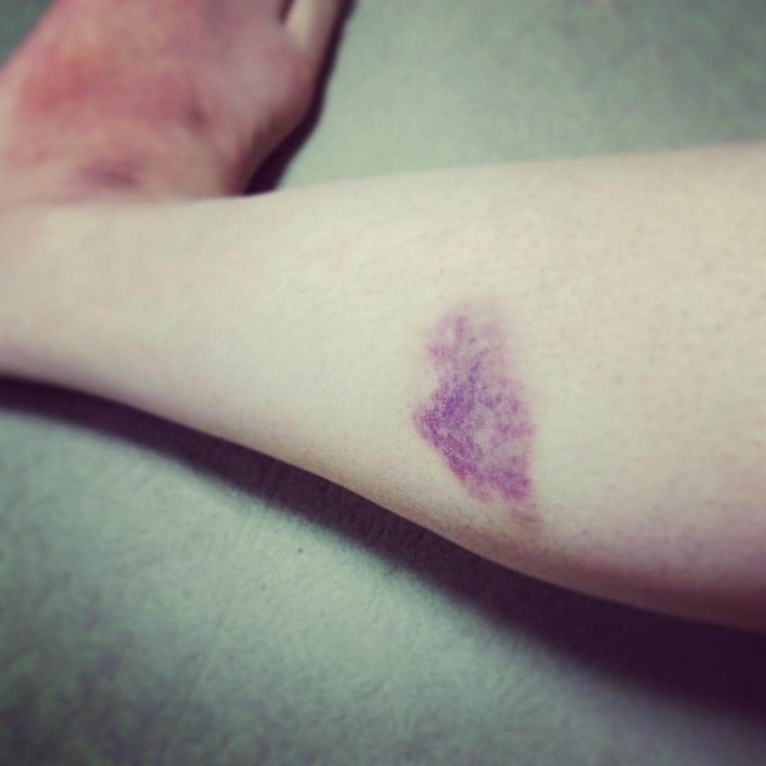 三角みづ紀さんのインスタグラム写真 - (三角みづ紀Instagram)「血管が脆いので出張帰りだいたい内出血します...ぎゃってなった。ちっとも痛くないのでウケる...。」11月6日 8時16分 - misumimizuki