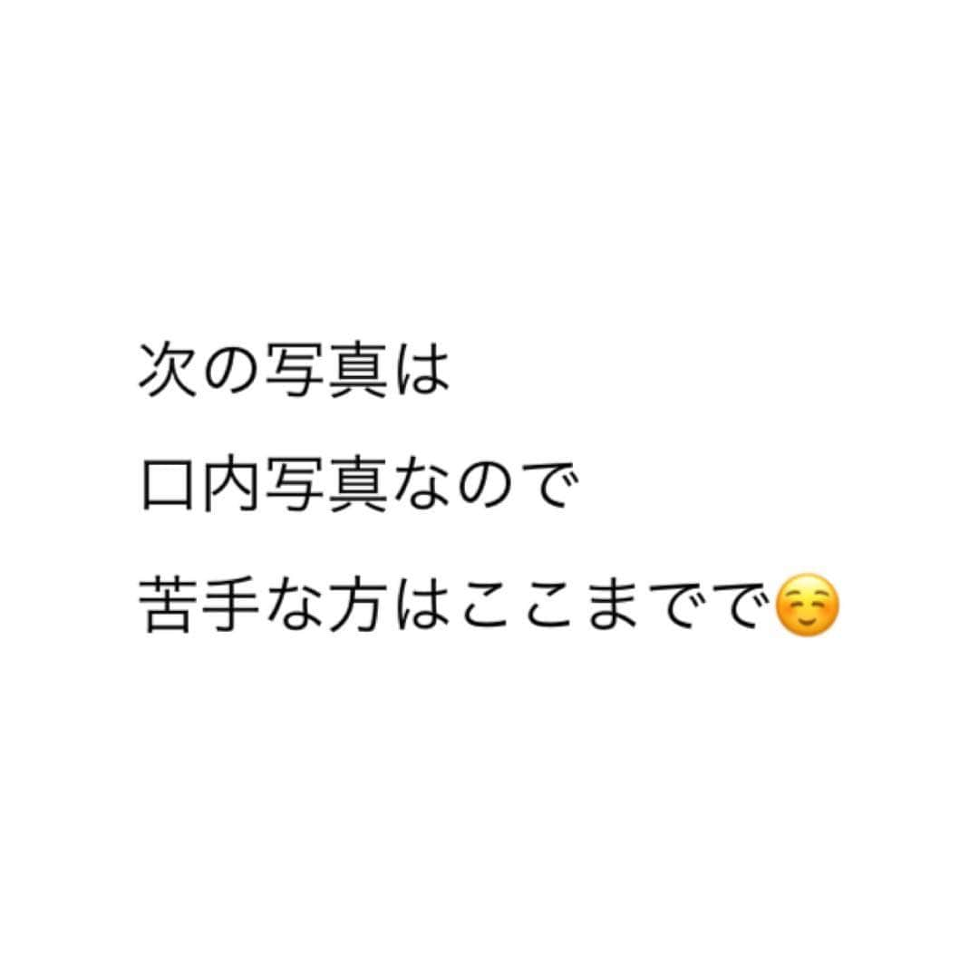 五十嵐茉優さんのインスタグラム写真 - (五十嵐茉優Instagram)「ㅤㅤㅤ 親にも友達にも最近 前よりもよく笑うようになったねって 言われるようになった☺️ ㅤ 前に言っていた セラミックでの歯列矯正が だいぶ進んできました✨ 仮歯生活はもうちょっと不自由なのかな？ と思っていましたが 思いのほか特になにも不自由なく 過ごせています〜☺️ 口内写真を4枚目に載せているので 苦手な人は2枚目までで💭 @sbcd_chiba @keizo_natori #湘南美容歯科 #セラミック #セラミック矯正 #美容歯科 #審美歯科 #歯科 #ホワイトニング #歯 #スマイル #笑顔 #歯並び #湘南美容 #湘美女 #美活 #美容day #自分磨き #綺麗になりたい #美意識 #湘南レポ」10月17日 12時32分 - mau08us