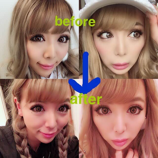 のインスタグラム：「今日ゎ大阪TAクリニックへ😍4Dノーズの一週間検診に行ってきたよ🤗  一週間しか経ってないのに、こんな素敵なお鼻です🤩 ダウンタイム全然ないからほんまにありがたいです🤣  こんなに変わったからいっぱい写真載せときます！わかりやすい before afterの写メ貼り貼りーー😍 耳の軟骨をとらなくても、メッシュ状のボールを入れて簡単に鼻先を出せる施術！！！ そして @motohiko.takesaki 先生なら５分で施術終わり！！🤩 ダウンタイムはほとんどなし！  いい事しかないこの施術、、 鼻悩んでたらぜひやってほしいな😍  鼻で顔って変わると思うんやけどやっぱやってよかったわ！って改めて思う😍 また更に前より自信持てた気がしてます笑笑🤣 先生ありがとう！(〃ω〃) #大阪#心斎橋#taクリニック#美容整形#美容外科#鼻#4dノーズ  #銀座#東京#劇的ビフォーアフター #芸能人#名医#セクシー女優#ギャル」