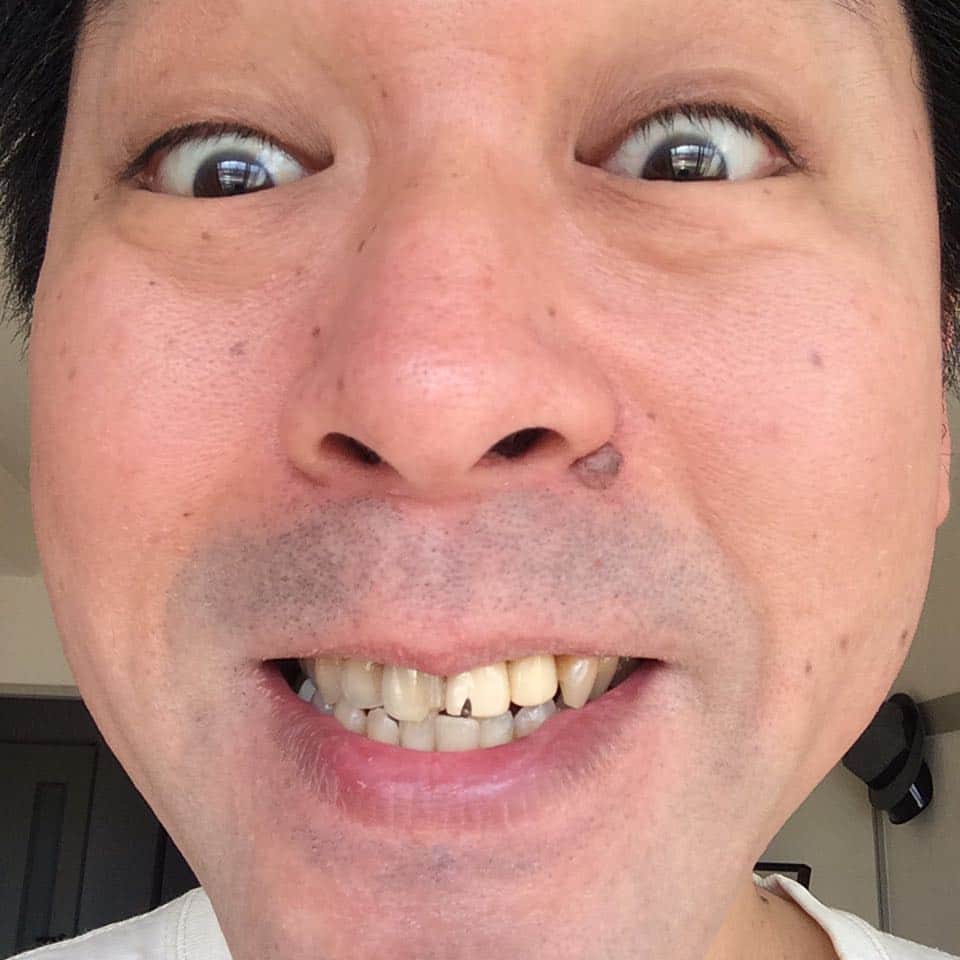 金剛地武志のインスタグラム：「【悲報】前歯の差し歯が欠けました」