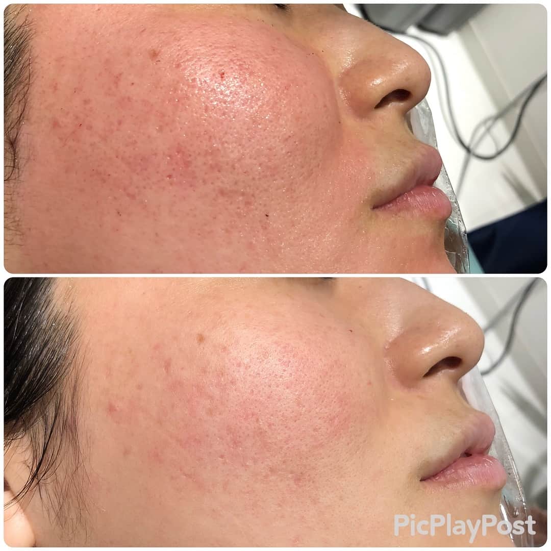 東京イセアクリニックさんのインスタグラム写真 - (東京イセアクリニックInstagram)「【ダーマローラー＋PRX治療】 . ニキビ跡のクレーターや毛穴を撃退❗️ 肌質を改善します👼🏻🌟 PRXを塗り込み、ダーマローラーを転がしていきます💉 . . 1枚目  写真上:施術直後  写真下:before . 個人差はありますが、 一般的に赤みはこの程度です🌻 . 💉麻酔:麻酔クリーム・笑気麻酔 ⚠️赤み・火照り・ザラつき:数日 👼🏻翌日からお化粧🆗 👛¥27000 . ダウンタイムが短いため長いお休みが取れない方 男性にもオススメです💁🏼‍♀️💁🏼‍♂️ . . #銀座#ginza  #iseaclinic#イセアクリニック #美容整形#美容外科#美容皮膚科  #美容#整形#プチ整形 #毛穴#毛穴レス #スキンケア#skincare #PRX#マッサージピール #ダーマローラー#dermaroller #ニキビ#ニキビ治療#炎症#ニキビ跡#凹み #クレーター#美肌#肌活#陶器肌 #綺麗になりたい#可愛くなりたい」11月15日 14時40分 - iseaclinic