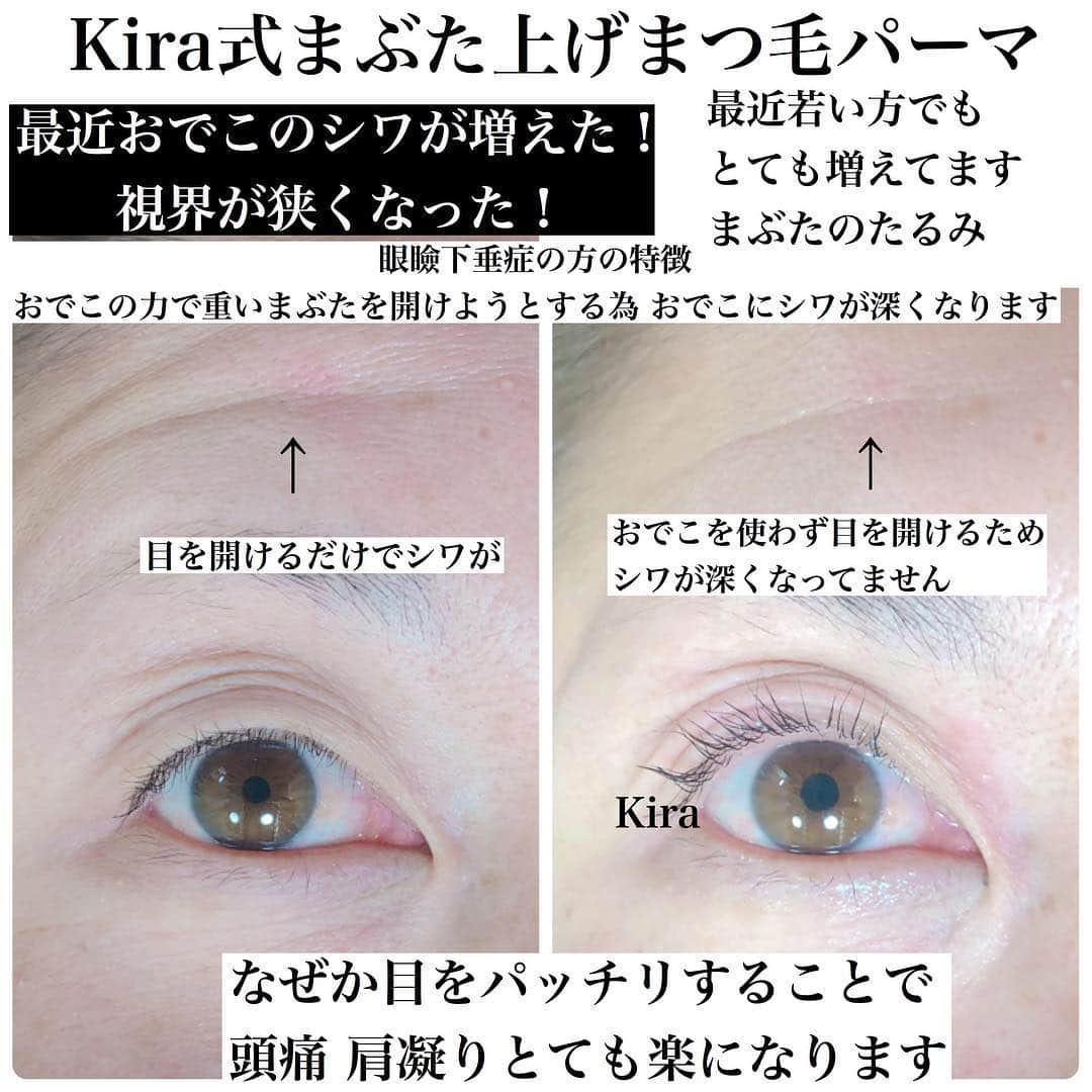 KIRAさんのインスタグラム写真 - (KIRAInstagram)「人から「眠そうだね」と言われる、おでこにしわが増えた、視界が狭くなった……こんな症状が気になる人はいないだろうか。 　もしかすると、それは「まぶたのたるみ」が原因かもしれない。まぶたが垂れ下がり、上まぶたが開きにくくなることを「眼瞼下垂（がんけんかすい）」といい、最近この病気に悩まされる人が増えているのだ。しかも、従来は中高年に多い疾患とされてきたが、近年は20～30代の若い世代にも発症する人が増加しているという。  眼瞼下垂症で調べると ほんと ほっておけない 病気なんだってことわかります。  アイリッドアップパーマでも 解消される方多いです 少しでも 進行を止める為にも 眼瞼下垂症対応の まぶた上げまつ毛パーマは喜ばれます。  ご質問・ご相談 気軽にお問い合わせ下さい😊 ・ #まつ毛パーマ #まぶた上げパーマ #ラッシュパーミングアイリスター#ラッシュパーミング#輝式まぶた上げ #眼瞼下垂症#アイリスト#下まつ毛パーマ #美容師 #美容室 #まつ毛パーマセミナー #アイリスト #まぶたが柔らかい #アイリッドアップパーマ #まつ毛カラー #ラッシュリフト  #ラッシュパーミングアイリスター #ラッシュリフト #マツエク#まつ毛エクステ #まつげエクステ  #パーマ #まつエク #eyelash #まつ毛 #一重まぶた #二重まぶた #まつげ #下まつ毛 #松本まつげパーマ #LashPermingeyeListar#経営者#整形」11月24日 8時41分 - thekirastory