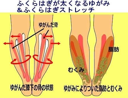 中目黒整体レメディオ 院長　渡邉潤一さんのインスタグラム写真 - (中目黒整体レメディオ 院長　渡邉潤一Instagram)「： 【ふくらはぎが太くなるゆがみ＆ふくらはぎストレッチ】  ふくらはぎが太い方は、膝下の骨がゆがんでいます。  例えば、内股の状態ですと股関節や太ももの骨（大腿骨）は内側にねじれるような形でゆがみます。 その流れを引き継ぐように膝下の骨も図の様に内側にねじれるように歪みます。  この時、膝寄りの部分では図のように外側に開くよう状態になります。 筋肉の癖としては、斜め後ろに広がるような格好で筋肉が膨らんでいきます。  また、関節がゆがんだことで、膝の後ろを流れる血管を締め付けるのでふくらはぎをむくませます。  老廃物は非常に脂肪と仲良しなので、むくんだ状態でいると老廃物が脂肪を呼び、さらに仲良く手を結び（結合）、セルライトへと変化して、ふくらはぎが太くなっていきます。  これが、ふくらはぎがゆがみによって太くなってしまう骨格的な原因です。 . . それでは、ふくらはぎのストレッチをご紹介します。  文章だけでは分かりにくいかと思います。 ブログの方に図解説明がありますので、よろしければ、そちらも合わせてご覧ください。 . . ストレッチ手順：  ①両足を前に伸ばし座ります。その際、骨盤は立てる様にして下さい。  ②片側の脚を膝のすぐ上の太ももにおきます。 伸ばしている脚は、つま先が内側や外側に倒れないように気をつけて下さい。  ③伸ばしている脚と同じ側の手でつま先をつかみ、上半身を起こすようにしながら、踵を床から上げるように、手で引き上げて下さい。  回数：３回～５回　３０秒前後  ふくらはぎ・膝の裏が体が硬い方は、③の様に持ち上げる事が難しいかと思います。その場合、踵を浮かさずにつま先を引き寄せるだけでも十分効果的です。 . . 詳しくは、 プロフィールのブログURLから ↓ テーマ別 ↓ ・下半身太り 太ももふくらはぎ 原因治し方 ・パーツ別矯正ストレッチ ↓ 【タイトル】 ・ふくらはぎが太い 膝下が太くなる原因 ・改善ストレッチ｜太ももの裏　ふくらはぎ　むくみ解消 を、ご覧ください。 . . . 💮施術をご希望の方へ💮  中目黒整体レメディオ 骨盤・美脚コース：施術は僕が行います。 ご予約はHPの予約フォームか、プロフ欄の電話する（☎0357735977）にてご連絡ください。 HPへは、ブログ記事下のバナーよりアクセスできます。 . . . #ストレッチ #o脚矯正 #x脚矯正 #膝下o脚 #XO脚 #大転子 #骨格矯正 #骨盤矯正 #産後骨盤矯正 #下半身太り #下半身痩せ #太もも痩せ #反り膝 #反り腰 #骨盤の歪み #脚やせ #むくみ #整体 #姿勢矯正#中目黒 #中目黒整体レメディオ #美脚になりたい #レメディオ #インスタダイエット #尻トレ #くびれ作り」12月9日 18時49分 - remedio_watanabe