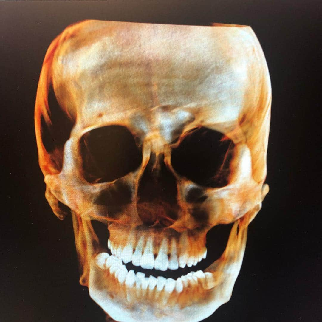 長澤和輝さんのインスタグラム写真 - (長澤和輝Instagram)「Skull nagasaman💀💀💀 #ct #rayscan #世界初 #ワンショットセファロ #フェイススキャン #ミライズ矯正歯科 @mirisekyouseishika #長澤和輝 #東京医科歯科大学」12月20日 18時24分 - nagasaman1216