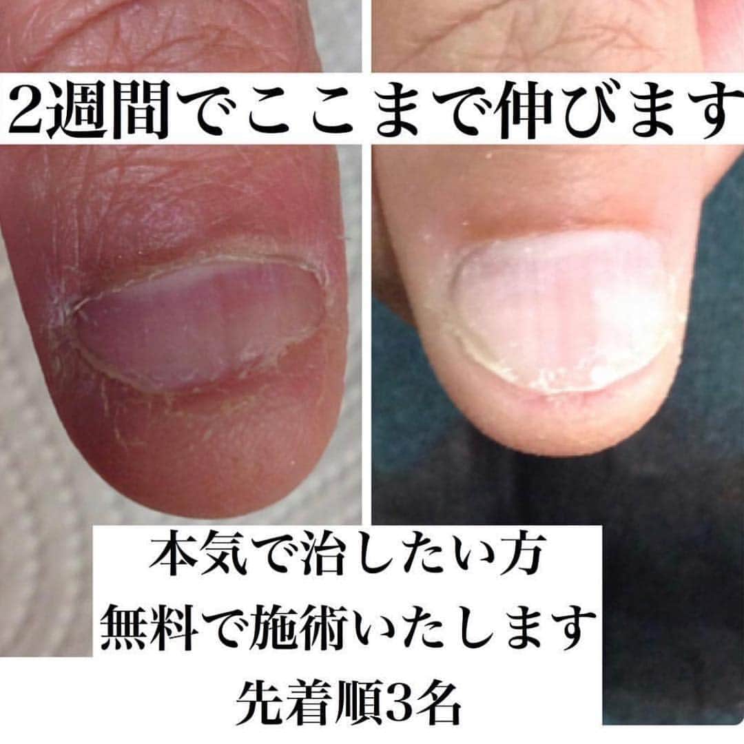 KIRAさんのインスタグラム写真 - (KIRAInstagram)「深爪育整  深爪による爪や指の変形を育整した症例です ・ この技法はスカルプは使用していません ・ ただジェルをのせるわけでもありません ・ 長年の経験から生み出された技法を使用しています ・ 深爪を改善する技法は たくさんありますが この技法はとにかく早く改善する技法です ・ とかく 深爪の方は 噛んだり むしったりが 癖になってしまっているので少しでも早く改善してあげなければいけません ・ セミナー日程 ・ 新宿  2月24日10時半〜14時半  大阪 2月21日10時半〜14時半 ・  育整の為のネイルケア 深爪技工士技法 深爪矯正 ・ 爪育整法 爪荒れ 剥離症 変形 変色 反り爪 短爪症 平爪 小爪 男爪 爪の凸凹 ・ #諏訪#長野市#佐久市#上田市#松本市#軽井沢町#美爪#ネイル#ネイルご質問・ご相談 #ジェルネイル#ジェルアート#ジェル#ネイル#女子力#ビジュー#浮かないジェルネイル#爪育整法#深爪再生#深爪緩和#深爪再生#噛み癖#むしり癖#深爪再生セミナー#短期深爪再生#ネイリスター#ネイリスト#メディカルネイリスター#トラブルネイル＃深爪技工士#東京セミナー#大阪セミナー ご質問・ご相談はDM、メール✉からお気軽にお問い合わせください😊」1月15日 16時52分 - thekirastory