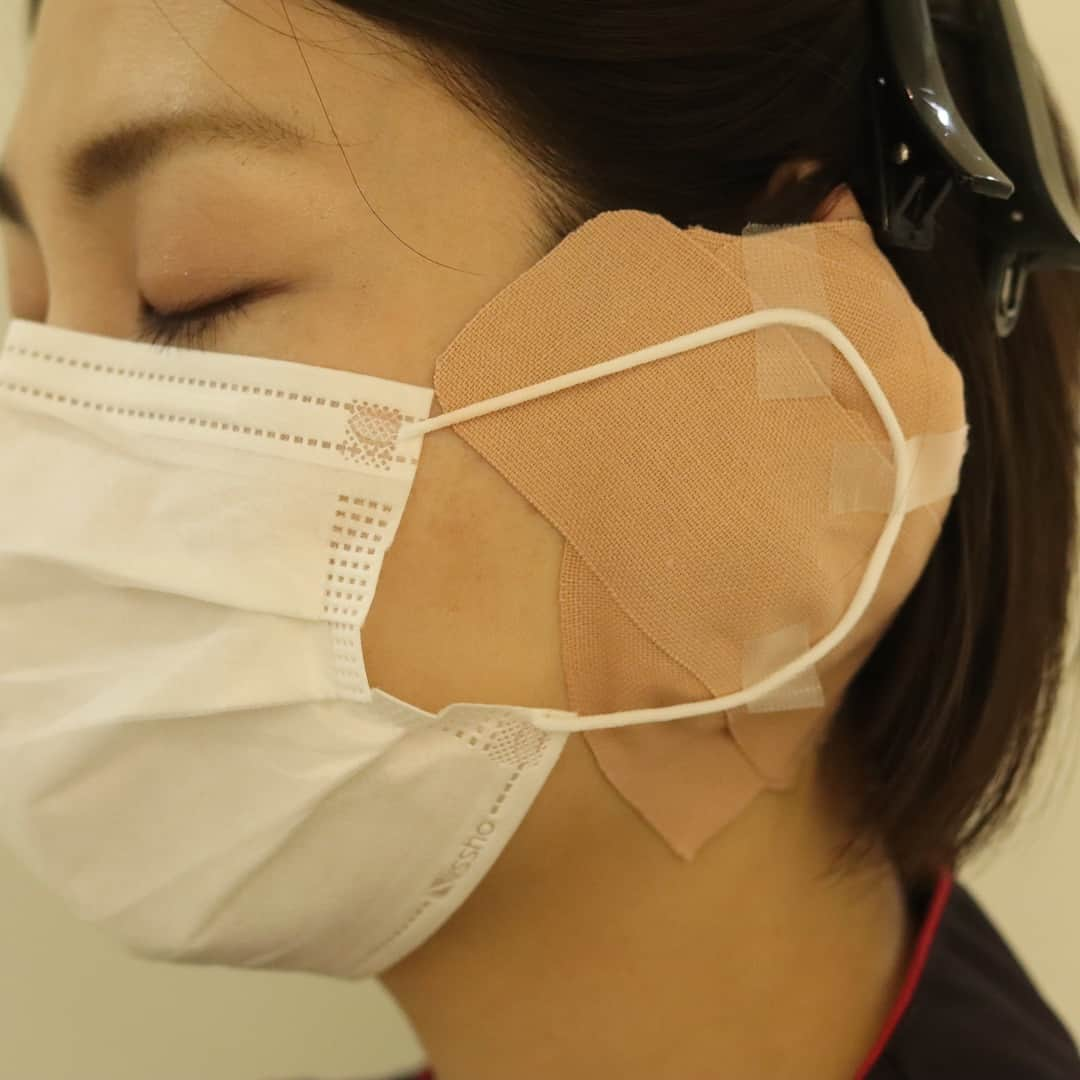 東京イセアクリニックさんのインスタグラム写真 - (東京イセアクリニックInstagram)「👨🏻‍⚕️ 術後の圧迫固定 👨🏻‍⚕️ . . 鼻尖形成や鼻中隔延長などの際に行う 【耳介軟骨移植】 . 術後は2-3日間圧迫固定が必要になります🤕💦 . マスクの着用は可能😷✨ . 女性であれば髪の毛で隠すことも🙆🏻‍♀️✨ 男性や髪の短い方は大きめの帽子・ニット帽等の持参をオススメします🎩 . 眼鏡やサングラスは掛けにくくなります💦 . 2-3日後🏡ご自宅で外して頂きますが 心配な方は再診にお越し頂いております👩🏻‍⚕️️🚑 . #銀座#ginza  #iseaclinic#イセアクリニック #吉種克之  #美容整形#美容外科#美容皮膚科 #整形#プチ整形#鼻整形#鼻尖形成 #鼻中隔延長#軟骨#自家軟骨#耳介軟骨移植#術後固定 #鼻筋#美鼻#レディエッセ#プロテーゼ#eライン#横顔美人 #整った鼻筋#プライスレス#snsモニター #セット割引 #割引 #綺麗になりたい#可愛くなりたい」1月17日 10時36分 - iseaclinic