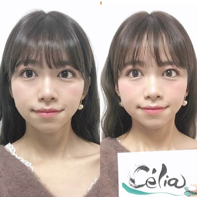 のインスタグラム：「. ( 左 before / 右 after ) . 本当にいい小顔サロン見つけたので 紹介させてください！🍑 . 先月から @celia_20180201 さんに 通ってるんだけれど 顔がシュってなるし、周りからも 小さくなった？って言われるくらい 目に見て分かるから伝えたい😢✨ . 顔がリフトアップされて、 顔の歪みの左右差もましになるし 目の開きやクマも術前と違うんです🥺 . 女性のスタッフさんがしてくれるんだけど 中目黒のプライベートサロンで 頭からデコルテ、脇のリンパまで流してくれるの👏🏻💗 . 時間はしっかりコースがおすすめ！ 友達から教えてもらったサロンで みんなもよかったら試しに行ってみてね🌸 . . . . . . #美容好きな人と繋がりたい#美容#小顔矯正#ヘッドスパ#小顔#おすすめ#中目黒#女子力アップ#ビフォーアフター#celia#リンパマッサージ#マッサージ#歪み矯正#女の子」