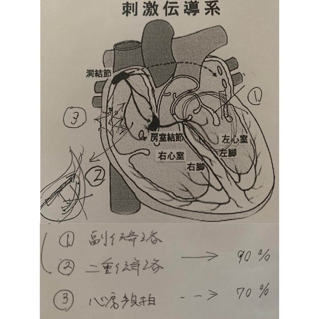 寺下智香（プロボウラー）さんのインスタグラム写真 - (寺下智香（プロボウラー）Instagram)「発作を誘発でき、原因がわかり、治療することができました😢  生まれつき、房室結節に２つの回路がありその１つが発作を起こしていた原因でした💦 その原因の伝路を焼灼してもらいました。  無事治療も終わり、麻酔のせいで昨日は吐き気との戦い😖 今さっき家に帰ってきてやっと終わったんだなぁとホッとできたところです✨  皆様ご心配ありがとうございました‼️ また元気に笑顔で頑張ります😊  #発作性上室性頻拍  #房室結節回帰性頻拍  #カテーテルアブレーション #治療できました #ありがとうございました」4月4日 17時25分 - chika507