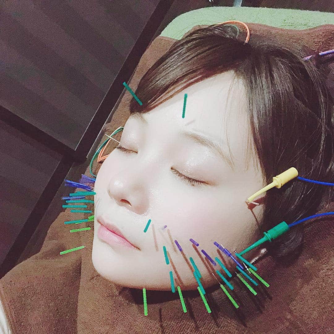のインスタグラム：「昨日は人生初、鍼してきたよ💆‍♀️ . 怖かったんだけど 想像よりも全然痛くなくて 即効で効くから 顔がスッキリしてて 杉崎先生凄い👏ってなった☺️ . アフターケアも頑張ります👮‍♂️ ありがとうございました♡︎ʾʾ . #杉崎先生 〔 @sugizakikenya 〕 . #きゅきゅっと美容鍼 #BCARAT式美容鍼 #BCARATbykoritorinic #BCARAT #Beauty #Body #Balance #笹塚 #笹塚美容鍼  #美容鍼 #美顔鍼」