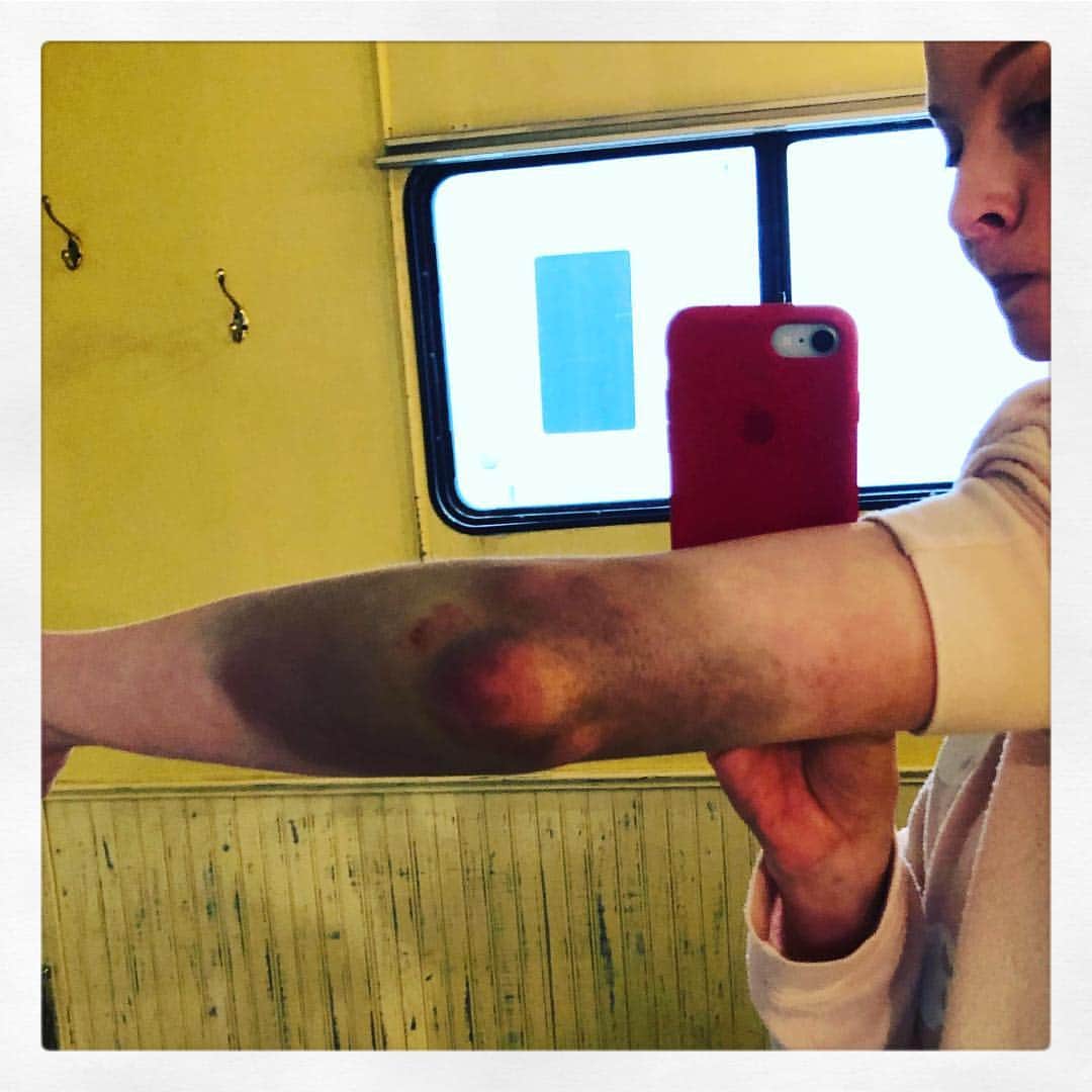 レイチェル・ニコルズさんのインスタグラム写真 - (レイチェル・ニコルズInstagram)「DO NOT WORRY: I slipped and fell directly onto my elbow with my whole body weight on a sneaky patch of black ice. There is no foul play exhibited here. But this is the gnarliest bruise I have ever had, so I wanted to share. 😳😳😳.」4月6日 3時55分 - ticklenichols