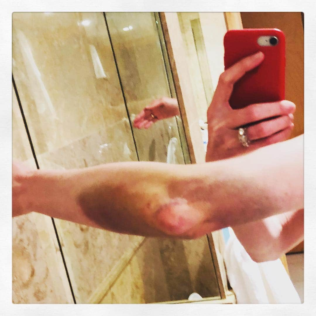 レイチェル・ニコルズさんのインスタグラム写真 - (レイチェル・ニコルズInstagram)「Many of you were worried about my monster bruise and I greatly appreciate your concern, so I wanted to let you all know that it’s healing, slowly but surely!」4月8日 0時42分 - ticklenichols