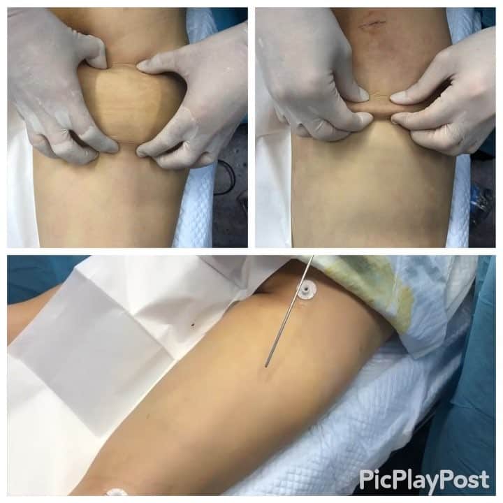 のインスタグラム：「#中国人 の患者様に対する#太もも 後面の脂肪吸引！患者様は#リピーター 様です。当院は中国人スタッフがおり、中国語対応可能ですので#中国 からたくさんの患者様がご来院されます！ 【#liposuction #beforeandafter (immediate) For watch the full video :YouTube:sbctakeda-liposuction あの有名な竹田先生による脂肪吸引の#ビフォーアフター （手術直前と手術直後の比較写真およびその術中動画です）】 ٩(๑❛ᴗ❛๑)۶ ぜひ竹田先生の オフィシャルホームページも ご覧ください！！ 竹田啓介 オフィシャル  と検索するか、以下のアドレスへ！  http://shiboukyuuin-takeda.com/#  #湘南美容外科 #湘南美容クリニック新橋銀座口院 #脂肪吸引 #豊胸 #根こそぎ #竹田 #竹田先生 #相川佳之 #美容外科 #美容整形 #横浜 #ダイエット #sbc #SBC #liposuction #followme #脱毛 #新橋 #新橋銀座口 #銀座 #コリドー街 (๑･̑◡･̑๑)」
