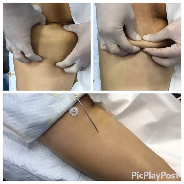 のインスタグラム：「#中国人 の患者様に対する#太もも 後面の脂肪吸引！患者様は#リピーター 様です。当院は中国人スタッフがおり、中国語対応可能ですので#中国 からたくさんの患者様がご来院されます！ 【#liposuction #beforeandafter (immediate) For watch the full video :YouTube:sbctakeda-liposuction あの有名な竹田先生による脂肪吸引の#ビフォーアフター （手術直前と手術直後の比較写真およびその術中動画です）】 ٩(๑❛ᴗ❛๑)۶ ぜひ竹田先生の オフィシャルホームページも ご覧ください！！ 竹田啓介 オフィシャル  と検索するか、以下のアドレスへ！  http://shiboukyuuin-takeda.com/#  #湘南美容外科 #湘南美容クリニック新橋銀座口院 #脂肪吸引 #豊胸 #根こそぎ #竹田 #竹田先生 #相川佳之 #美容外科 #美容整形 #横浜 #ダイエット #sbc #SBC #liposuction #followme #脱毛 #新橋 #新橋銀座口 #銀座 #コリドー街 (๑･̑◡･̑๑)」