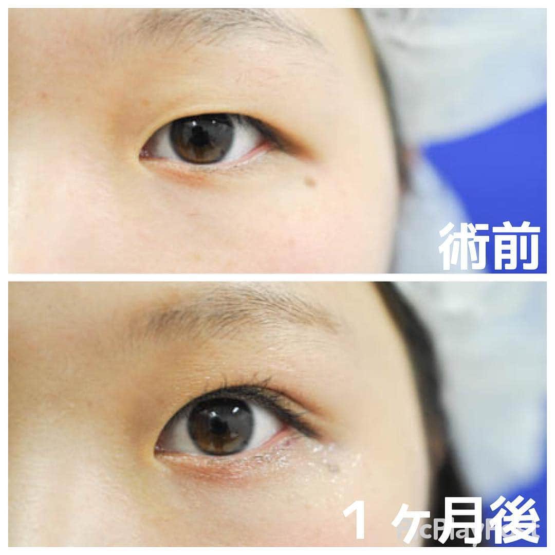 のインスタグラム：「『全国からInstagram指名殺到中！』 『二重術👁』なら湘南美容クリニックベテランDrの竹田にお任せください💪💪 . 🏥湘南美容クリニックで１５年間活躍。銀座・新橋エリア全ての美容クリニックの中で最大規模の『新橋銀座口院』の院長です👨‍⚕️💓 . 『二重整形・クイックコスメティークダブル』徹底したデザインと綺麗な二重にこだわりがある方はぜひご相談にいらしてください！細かい調整など一緒に考えながら希望を叶えましょう！🤝🤝 . 🎥YouTube症例掲載数ナンバーワン！(sbctakeda-futae)🎥 . 湘南美容クリニックエリア統括ドクター👨‍⚕️ としてみなさまのご希望にお応えします！ . 🌟ご予約の際は「竹田先生のインスタを見た」とお伝えいただくとご案内がスムーズに進みます😉 . もしくはこのインスタ宛にメッセージ💌を送ってください！診療時間を気にすることなく仮予約をお取りすることができます。 . 銀座・新橋エリア最大規模の美容クリニック『新橋銀座口院』でお待ちしております❣️ . ☎︎0120-549-695 . #美容外科 #湘南美容外科 #美容 #整形 #根こそぎ #竹田啓介 #美容好きな人と繋がりたい #二重整形 #二重 #平行二重 #末広二重 #クイックコスメティークダブル #美容大好き #新橋 #六本木 #銀座 #アイメイク #埋没法 #美魔女 #埋没法経過 #プチ整形 #クイックコスメティークダブル #二重術セレクション」