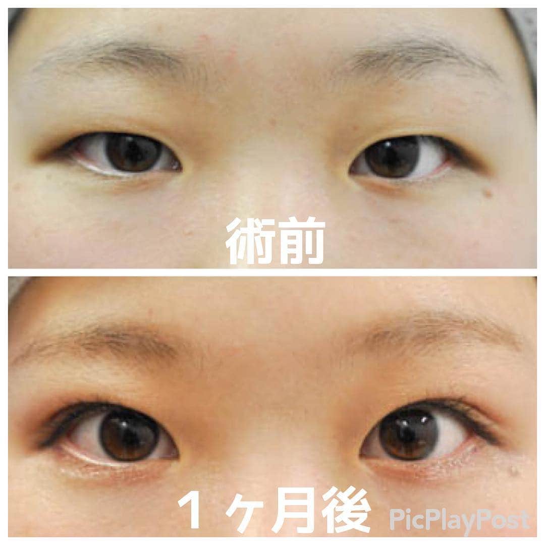 竹田 啓介（湘南美容外科）さんのインスタグラム写真 - (竹田 啓介（湘南美容外科）Instagram)「『全国からInstagram指名殺到中！』 『二重術👁』なら湘南美容クリニックベテランDrの竹田にお任せください💪💪 . 🏥湘南美容クリニックで１５年間活躍。銀座・新橋エリア全ての美容クリニックの中で最大規模の『新橋銀座口院』の院長です👨‍⚕️💓 . 『二重整形・クイックコスメティークダブル』徹底したデザインと綺麗な二重にこだわりがある方はぜひご相談にいらしてください！細かい調整など一緒に考えながら希望を叶えましょう！🤝🤝 . 🎥YouTube症例掲載数ナンバーワン！(sbctakeda-futae)🎥 . 湘南美容クリニックエリア統括ドクター👨‍⚕️ としてみなさまのご希望にお応えします！ . 🌟ご予約の際は「竹田先生のインスタを見た」とお伝えいただくとご案内がスムーズに進みます😉 . もしくはこのインスタ宛にメッセージ💌を送ってください！診療時間を気にすることなく仮予約をお取りすることができます。 . 銀座・新橋エリア最大規模の美容クリニック『新橋銀座口院』でお待ちしております❣️ . ☎︎0120-549-695 . #美容外科 #湘南美容外科 #美容 #整形 #根こそぎ #竹田啓介 #美容好きな人と繋がりたい #二重整形 #二重 #平行二重 #末広二重 #クイックコスメティークダブル #美容大好き #新橋 #六本木 #銀座 #アイメイク #埋没法 #美魔女 #埋没法経過 #プチ整形 #クイックコスメティークダブル #二重術セレクション」3月16日 17時09分 - nekosogitakeda