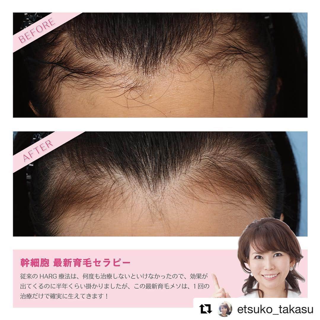 高須クリニック栄院さんのインスタグラム写真 - (高須クリニック栄院Instagram)「#Repost @etsuko_takasu with @get_repost ・・・ 女性は更年期を過ぎたあたりから、女性ホルモンが減少していくので、女性の薄毛でお悩みの方はとても多いですが、従来のHARG療法より1回の治療効果がかなり高い、最新育毛治療をご紹介します。 ・ 50代女性です。 前髪の薄毛で、ボリュームが出ずにペチャンとなってしまう事がお悩みでした。 生え際に注射したところだけ、フサフサ生えてきました！ 1回メソセラピー注射しただけで、この効果です！！ ・ 今までのHARG療法は、何度も治療しないといけなかったので、効果が出てくるのに、半年くらい待っていましたが、この新しい育毛メソは、1回の治療だけで、確実に生えています！ 髪が伸びるスピードがあるので、その期間はお待ち頂きますが、1回だけで効果が出たことは、患者さまのご負担もかなり楽になりました♫ （注射は、麻酔のクリームを塗ってから行いますので、痛みは軽減されます） ・ 基本的には、メソセラピー注射した範囲だけ髪が生えてきますので、注射していない部分は生えてきませんので、ご了承ください。 ・ 【料金】 ●幹細胞 新育毛メソセラピー ハガキ1枚分の範囲：400,000円（税別） ※料金は2019年3月8日現在 ※保険適用外、自由診療 ・ 【副作用・リスク】 ●注射による内出血 ●アレルギー（麻酔、薬剤） ・ 【ご予約・お問い合わせ】 名古屋院☎︎ 052-564-1187 栄院☎︎ 052-971-6650 名古屋院📱 @takasuclinic_nagoya 栄院📱 @takasuclinic_sakae ↑両院インスタのプロフィール画面からも直接コンタクトが取れます📲 https://www.takasu.co.jp/ ・ ・ #高須クリニック #高須幹弥 #高須英津子 #美容整形 #整形 #二重 #埋没法 #二重切開 #ヒアルロン酸 #鼻 #ニキビ #薄毛治療 #たるみ #眼瞼下垂 #シワ #ほうれい線 #毛穴 #目 #整形したい #美容好きな人と繋がりたい #可愛くなりたい #綺麗になりたい #平行二重 #末広二重 #プチ整形 #二重整形 #目尻切開 #目頭切開 #ビフォーアフター」3月16日 18時55分 - takasuclinic_sakae