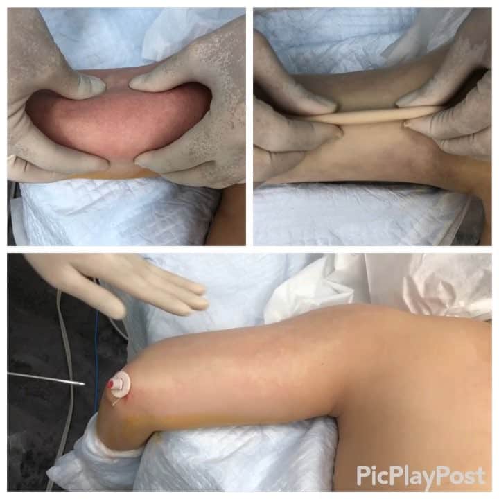 のインスタグラム：「10kg太ってしまったので脂肪吸引で#二の腕 を細くする！その左#振り袖 の脂肪吸引の術中劇的変化！ 【#liposuction #beforeandafter (immediate) For watch the full video :YouTube:sbctakeda-liposuction あの有名な竹田先生による脂肪吸引の#ビフォーアフター （手術直前と手術直後の比較写真およびその術中動画です）】 ٩(๑❛ᴗ❛๑)۶ ぜひ竹田先生の オフィシャルホームページも ご覧ください！！ 竹田啓介 オフィシャル  と検索するか、以下のアドレスへ！  http://shiboukyuuin-takeda.com/#  #湘南美容外科 #湘南美容クリニック新橋銀座口院 #脂肪吸引 #豊胸 #根こそぎ #竹田 #竹田先生 #相川佳之 #美容外科 #美容整形 #横浜 #ダイエット #sbc #SBC #liposuction #followme #脱毛 #新橋 #新橋銀座口 #銀座 #コリドー街 (๑･̑◡･̑๑)」