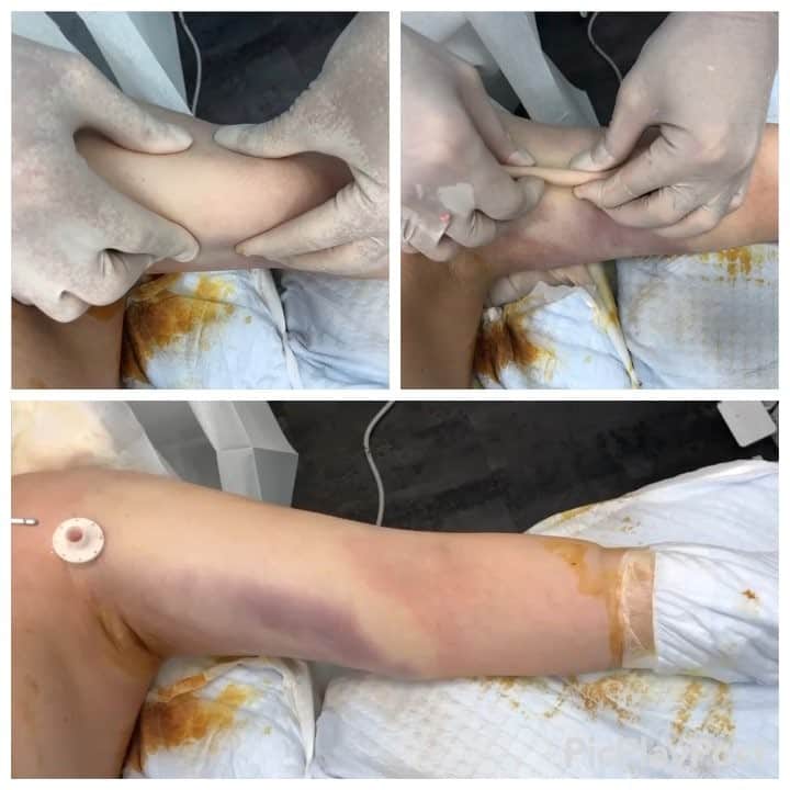 のインスタグラム：「10kg太ってしまったので脂肪吸引で#二の腕 を細くする！その左#力こぶ の脂肪吸引の術中劇的変化！ 【#liposuction #beforeandafter (immediate) For watch the full video :YouTube:sbctakeda-liposuction あの有名な竹田先生による脂肪吸引の#ビフォーアフター （手術直前と手術直後の比較写真およびその術中動画です）】 ٩(๑❛ᴗ❛๑)۶ ぜひ竹田先生の オフィシャルホームページも ご覧ください！！ 竹田啓介 オフィシャル  と検索するか、以下のアドレスへ！  http://shiboukyuuin-takeda.com/#  #湘南美容外科 #湘南美容クリニック新橋銀座口院 #脂肪吸引 #豊胸 #根こそぎ #竹田 #竹田先生 #相川佳之 #美容外科 #美容整形 #横浜 #ダイエット #sbc #SBC #liposuction #followme #脱毛 #新橋 #新橋銀座口 #銀座 #コリドー街 (๑･̑◡･̑๑)」