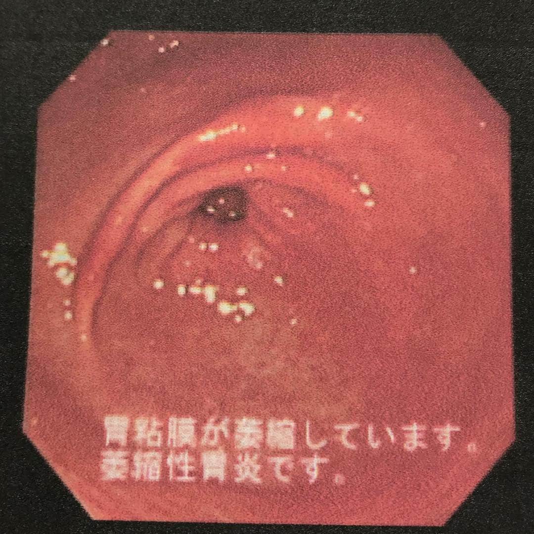 パーティ内山さんのインスタグラム写真 - (パーティ内山Instagram)「#十二指腸潰瘍 #胃炎 #療養中 #パーティ内山」3月16日 23時44分 - ruichanfamily