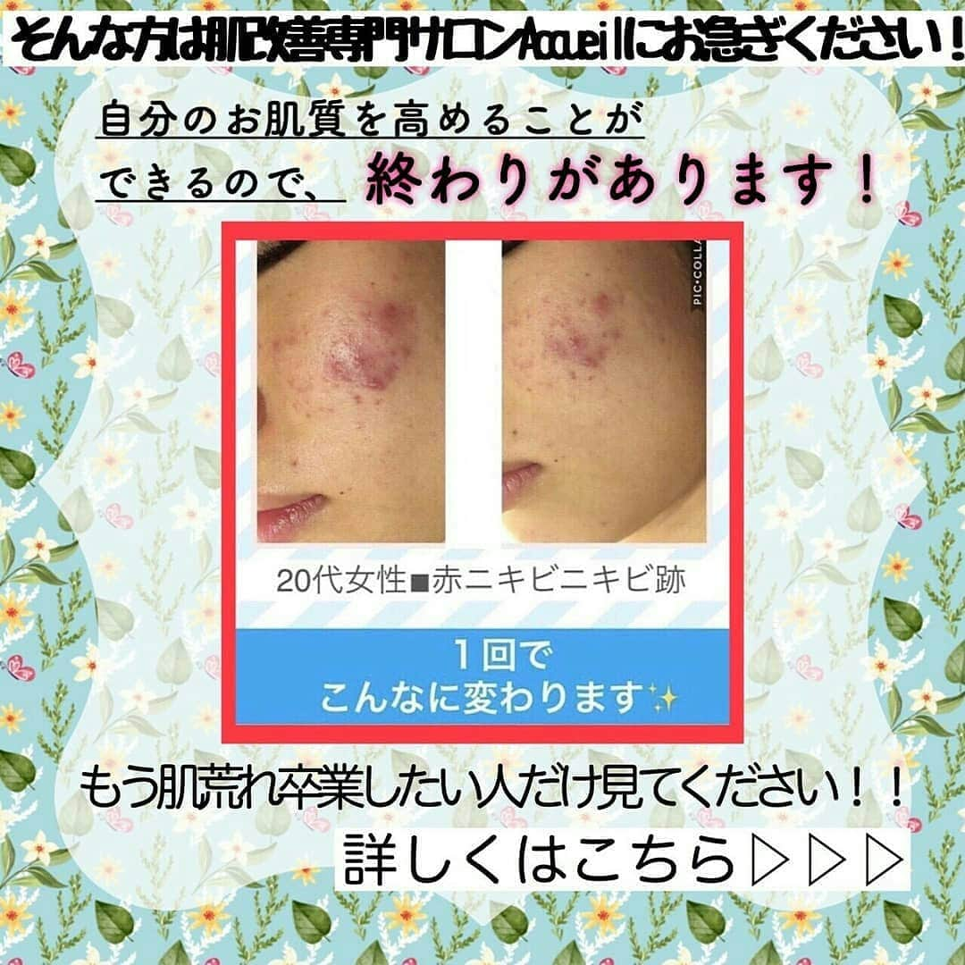 肌質改善専門サロン~Accueil~さんのインスタグラム写真 - (肌質改善専門サロン~Accueil~Instagram)「💙💚💛18日空きあり💛💜❤ * * 【ご予約はこちら👇🏼】 🌟🌟 @accueil_ikebukuro 🌟🌟 . ※今だけ期間限定クーポンあり . . . 肌荒れの原因は人それぞれなのにも関わらず、 周りの人と同じケアをしていませんか💦？？ * ❌お薬を塗っても飲んでも変わらない、、 ❌食事を気にしても肌が荒れる、、 ❌スキンケアを変えてもイマイチ、、 ❌何かしら常にトラブルが肌にある、、 ❌ニキビが繰り返しできる、、 * * そのお悩み解決できちゃいます😌✨ Accueilは、どのサロンに行っても良くならなかったお客さまたちや、 どの皮膚科に行っても変化がなかったお客さまたちが多く訪れてくださっています🙌💕* * * * もう悩まない！！！ 繰り返さないところまでしっかりと根本改善していきます☺️ そろそろ肌荒れから卒業しませんか？ * →→→初回体験はこちらから👉🏼 @accueil_ikebukuro * * * * Accueilでのお手当は、、 * 機械は一切使いません🙅‍♀️❌ 使うお化粧品は １００％天然の「ミネルヴァ化粧品」🌲🍃 ニキビの炎症がある方・アトピーの方でも 安心して受けていただける事ができる お肌にとても優しいエステです♡♡ * * お肌のお悩みなら、何でもお任せください😊💕 * * ■「インスタ見ました！」 で、 初回体験￥26,000 →→✨￥５，９８０✨ * * * --------当サロンのご予約方法≫--------- *  1️⃣当サロンのインスタTopのURL ⭐『Hotpepper Beauty』の 「instagram限定クーポン」にてご予約可能♡♡ * * 2️⃣インスタのDMからご予約 （下記項目を記載の上、お問い合わせください♪） * 🔶お名前（フルネーム） * 🔶お電話番号 * 🔶希望日時（第１～第３希望） * 🔶ご希望のメニュー * * 3️⃣お電話でのご予約✨ 　03-6912-5705にお願いします♡ ----------------------------------------- * * @accueil_ikebukuro ✨ #ニキビ #ニキビ跡 #毛穴 #乾燥肌 #ニキビ跡ケア #肌荒れ #ニキビ跡改善 #ニキビ肌改善 #ニキビ治療 #保湿 #毛穴の黒ずみ #毛穴の開き #スキンケア #毛穴吸引 #アトピー女子 #ニキビ皮膚科  #美肌ケア  #ニキビ専門 #肌質改善 #背中ニキビ #アトピー肌 #乾燥 #ニキビケア #毛穴ケア #アトピー治療 #肌悩み #スキンケア難民 #肌トラブル改善 #スキンケア大事 #目指せ美肌」3月17日 20時16分 - accueil_ikebukuro