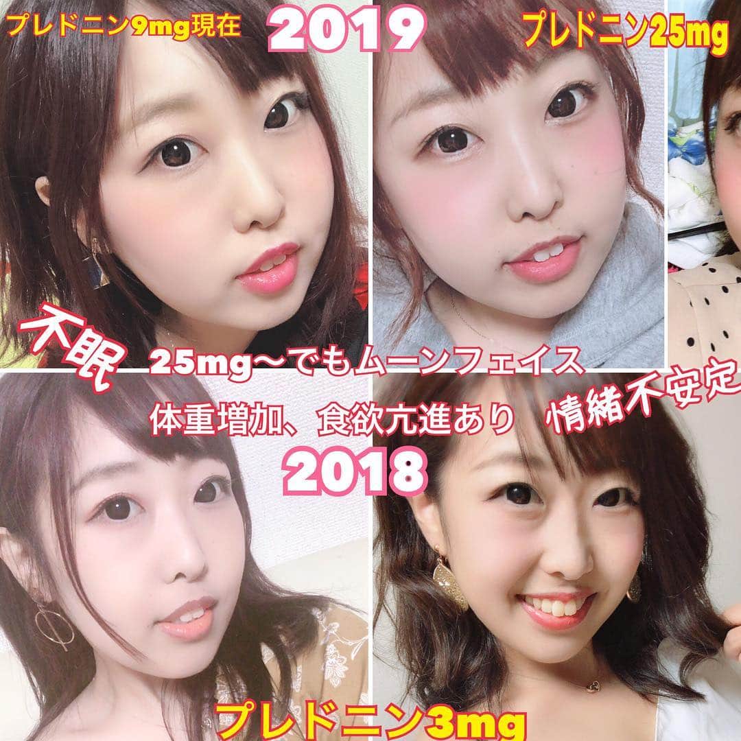 夏目亜季のインスタグラム：「#プレドニン の奇跡。 飲む量、服用期間によって顔変わる。 下のは再燃前。 右側は再燃前。 今回は25mgまで増えての減薬中で 今8mgやけど、顔元に戻るまで1年くらいかかりそう。 その中でまた薬ふえたらまた長くなる。 人生で顔痩せてる期間少なすぎる🐹🐰 まあそれも自分の運命😂💫 また3mgまでへってほしいな、#セルセプト が効いてる感じするし！ セルセプト追加してからヘモグロビン13.9とかやし、すごすぎる。 このまま一番はプレドニン0にして再燃せずがよろし😂 プレドニン0になったら奇跡レベル💫 いつもその途中で再燃してる😂 免疫抑制剤のおかげで一回3までさげれてるからさらに追加したわけやしまた下げられるかもしれんけど、限界超えると再燃してまた顔太るし副作用の戦い😂終わらない戦い😂 健康状態に関係ないけど #ムーンフェイス が嫌すぎるし、ステロイド飲んでると糖質とると太りやすくなるから、それもすごい嫌で、できれば減薬していきたいし、医師も思ってるけど、患者から再燃しないために、もう下げないでっていう人もいるみたい。ムーンフェイスとか太るのなければもう、下げないでっていってもいいけど、一番それが気になるからな😂複雑😂  #プレドニン 服用してるひとは参考にしてね😚  https://youtu.be/fL0GPc1HG2o 700人まであとすこし！チャンネル登録よろしくね😆❤️ 夏目亜季とバズっちゃお！Vol.17  Youtube 生配信  このアカウントから放送です↓ https://www.youtube.com/channel/UCnszw-clWSg2E8atn8t8Hmg 公演日:3/9(土)  OPEN:17:05 START17:15  観覧 前売:3000円 当日3500円  観覧/交流会:前売5000円 当日5500円  場所:東京都新宿区西新宿7-8-11 予約：https://tiget.net/events/49150 ※今回の会場はドリンク等がありません。 交流会での飲食物は皆さん持ち込み制となっています。 好きなものを持ち寄って自由に飲食してください。  ソロ活動2周年 ☆2ndワンマンライブ 公演日2019年3/23(土) 会場：新宿FNV OPEN10:45 START11:00 ※開演開場は前後する可能性があります 前売4000+1D 当日4500+1D 予約はこちら:https://tiget.net/events/35822 ☆ワンマンライブ打ち上げオフ会 15:30-17:30 参加費7000 場所新宿某所 通し予約特典あり！ 詳細、予約 https://tiget.net/events/49160  3月イベント 9 あきバズ 予約詳細 https://tiget.net/events/49150 夏目亜季とバズっちゃお！Vol.17  Youtube 生配信  このアカウントから放送です↓ https://www.youtube.com/channel/UCnszw-clWSg2E8atn8t8Hmg 公演日:3/9(土)  OPEN:17:05 START17:15  観覧 前売:3000円 当日3500円  観覧/交流会:前売5000円 当日5500円  場所:東京都新宿区西新宿7-8-11 予約：https://tiget.net/events/49150 ※今回の会場はドリンク等がありません。 交流会での飲食物は皆さん持ち込み制となっています。 好きなものを持ち寄って自由に飲食してください。 3/20若木萌さん生誕祭 若木萌生誕祭2019「Black Moon Night」 2019年3月20日（水）dues 新宿 東京都新宿区新宿3-28-4　 出演：若木萌 / 鈴木ゆき /夏目亜季 / アヤメアヤ シークレットゲスト♥有り 前売2500円 / 当日3000円(各+1D) 開場18:30 / 開演19:00 特典会 21:00 / 閉会22:00 23ワンマンライブ→オフ会 予約詳細 tiget.net/events/35822ワンマン tiget.net/events/49160 打ち上げオフ会 3/31 岸田健作さんヘルプマークイベント 新宿アルタにて公開収録 チケットはこちらから https://www.muevo.jp/campaigns/1888 放送局 :ニコニコ生放送※ネット配信局(ameba Fresh LIVEを予定)他各LIVE配信社 放送時間 :2019年3月31日(日)12:00-14:00(予定) 出演者 :岸田健作、オスマンサンコン、鼠先輩、長井秀和…他 放送尺 :約2～3時間予定  #梅カムこんぶ #梅カムこんぶPR大使  #舞鶴 #京都 #かわいい女の子 #可愛い  #東京カメラ部 #舞鶴市 #夏目亜季 #ヘルプマーク #SLE #全身性エリテマトーデス #トマオニアンバサダー #トマオニ #youtuber #youtuber好きな人と繋がりたい  #予防医療  #舞鶴 #京都 #かめらすきな人と繋がりたい  #個撮 #撮影会 #カメラマン募集 #カメラマンさんと繋がりたい #youtube」