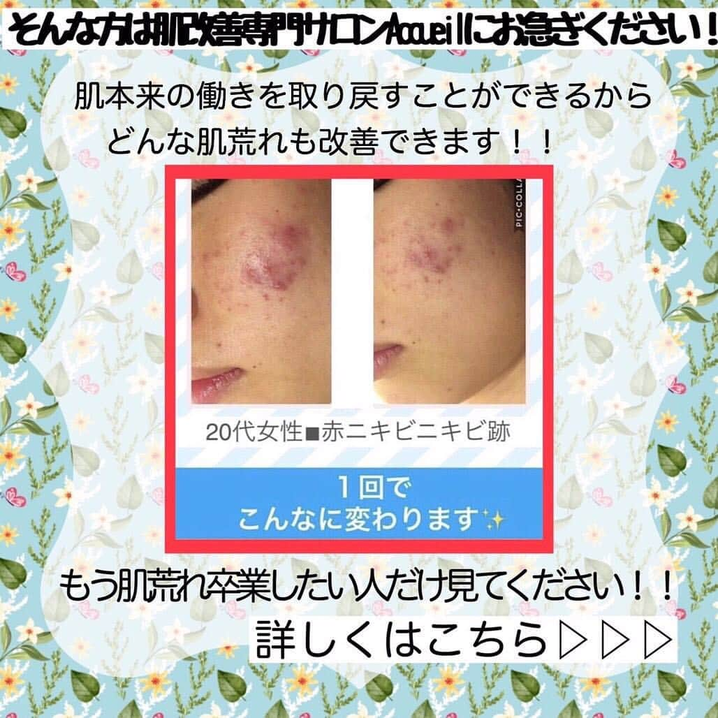 肌質改善専門サロン~Accueil~さんのインスタグラム写真 - (肌質改善専門サロン~Accueil~Instagram)「💙💚💛20日空きあり💛💜❤ * * 【ご予約はこちら👇🏼】 🌟🌟 @accueil_ikebukuro 🌟🌟 . ※今だけ期間限定クーポンあり . . . 肌荒れの原因は人それぞれなのにも関わらず、 周りの人と同じケアをしていませんか💦？？ * ❌お薬を塗っても飲んでも変わらない、、 ❌食事を気にしても肌が荒れる、、 ❌スキンケアを変えてもイマイチ、、 ❌何かしら常にトラブルが肌にある、、 ❌ニキビが繰り返しできる、、 * * そのお悩み解決できちゃいます😌✨ Accueilは、どのサロンに行っても良くならなかったお客さまたちや、 どの皮膚科に行っても変化がなかったお客さまたちが多く訪れてくださっています🙌💕* * * * もう悩まない！！！ 繰り返さないところまでしっかりと根本改善していきます☺️ そろそろ肌荒れから卒業しませんか？ * →→→初回体験はこちらから👉🏼 @accueil_ikebukuro * * * * Accueilでのお手当は、、 * 機械は一切使いません🙅‍♀️❌ 使うお化粧品は １００％天然の「ミネルヴァ化粧品」🌲🍃 ニキビの炎症がある方・アトピーの方でも 安心して受けていただける事ができる お肌にとても優しいエステです♡♡ * * お肌のお悩みなら、何でもお任せください😊💕 * * ■「インスタ見ました！」 で、 初回体験￥26,000 →→✨￥５，９８０✨ * * * --------当サロンのご予約方法≫--------- *  1️⃣当サロンのインスタTopのURL ⭐『Hotpepper Beauty』の 「instagram限定クーポン」にてご予約可能♡♡ * * 2️⃣インスタのDMからご予約 （下記項目を記載の上、お問い合わせください♪） * 🔶お名前（フルネーム） * 🔶お電話番号 * 🔶希望日時（第１～第３希望） * 🔶ご希望のメニュー * * 3️⃣お電話でのご予約✨ 　03-6912-5705にお願いします♡ ----------------------------------------- * * @accueil_ikebukuro ✨ #ニキビ #ニキビ跡 #毛穴 #乾燥肌 #ニキビ跡ケア #肌荒れ #ニキビ跡改善 #ニキビ肌改善 #ニキビ治療 #保湿 #毛穴の黒ずみ #毛穴の開き #スキンケア #毛穴吸引 #アトピー女子 #ニキビ皮膚科  #美肌ケア  #ニキビ専門 #肌質改善 #背中ニキビ #アトピー肌 #乾燥 #ニキビケア #毛穴ケア #アトピー治療 #肌悩み #スキンケア難民 #肌トラブル改善 #スキンケア大事 #目指せ美肌」3月19日 20時09分 - accueil_ikebukuro