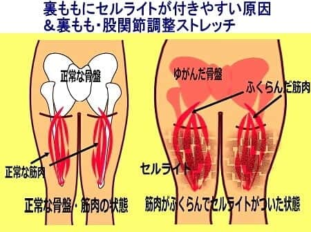 中目黒整体レメディオ 院長　渡邉潤一さんのインスタグラム写真 - (中目黒整体レメディオ 院長　渡邉潤一Instagram)「： 【裏ももにセルライトがつきやすい原因＆裏もも・股関節調整ストレッチ】  太ももの裏がたるみ、セルライトがつきやすいのは、整体学の観点から考察すると、骨盤の歪みによって引き起こされる２つことに起因すると考えられます。  ①骨盤が歪んだことで股関節のずれが起こり、正しく脚が使えないこと。 ②骨盤が歪んだことで坐骨の位置がズレ、太ももの裏の筋肉にストレスがかかること。  まず①ですが、これは「骨盤が歪むと股関節も必ず歪む」という特徴に起因します。 これは、体のバランスを正常に保とうとするために、股関節の位置がずれ、ゆがんだ骨盤を支えようとするからです。  このとき、ずれた股関節の可動域は狭くなります。そのため歩くや走るなどの動作のときに、根本的に動きが制限されます。  ②の理由ですが、骨盤が歪むということはその骨盤の一部である坐骨の位置がずれてしまいます。 それにより、坐骨から膝の裏側まで伸びている筋肉（ハムストリング群）にストレスがかかり、筋肉が過度に緊張しているために本来の力を発揮できず、代謝量（熱量）が低下するからです。  この２つのことが合わさり、太ももの裏側の脂肪は燃焼されずむくみもとれず、セルライトができて溜まってしまうのです。 . . それでは、ストレッチをご紹介します。  この方法は、ゆがみによって引き起こされた、股関節の詰まりの解消、裏ももの緊張を緩和させ新陳代謝をあげるストレッチです。 . . ストレッチ手順：  写真① 仰向けになり膝を立て、足の幅をお尻よりも大きく開きます。  写真② 足を持ち上げます。 股を出来るだけ開き、膝を約９０度になるようにします。  写真③ ②の状態を崩さないように、手で足を外側から掴み体の力を抜きます。 足は広がらないように注意して下さい。  回数： ３０秒～１分　３～５回 ※③のポーズの時に、無理に足を体に引き寄せないようにして下さい。 肩の力を抜くことで自然と手や腕の重みが伝わり、股関節に負荷をかけることが出来ます。 . . 詳しくは、 プロフィールのブログURLから ↓ テーマ別 ↓ ・下半身太り 太ももふくらはぎ 原因治し方 ・パーツ別矯正ストレッチ ↓ 【タイトル】 ・太もも裏側のたるみ セルライトの原因 ・改善ストレッチ｜股関節　太ももの付け根　ヒップアップ　骨盤のゆがみ を、ご覧ください。 . . 💮施術のご案内： 中目黒整体レメディオ 骨盤・美脚コース：施術は僕が行います。 ご予約はHPの予約フォームか、プロフ欄の電話する（☎0357735977）にてご連絡ください。 HPへのリンクは、ブログの各記事下にあります。 . . #裏もも #股関節 #セルライト #ストレッチ #o脚矯正 #x脚矯正 #膝下o脚 #XO脚 #大転子#大転子矯正 #骨格矯正 #骨盤矯正 #産後骨盤矯正 #下半身太り #下半身痩せ #太もも痩せ #ふくらはぎ痩せ #反り膝 #反り腰 #骨盤の歪み #脚やせ #ゆがみ #整体 #中目黒 #レメディオ #姿勢矯正 #中目黒整体レメディオ #リポスト」3月20日 18時19分 - remedio_watanabe