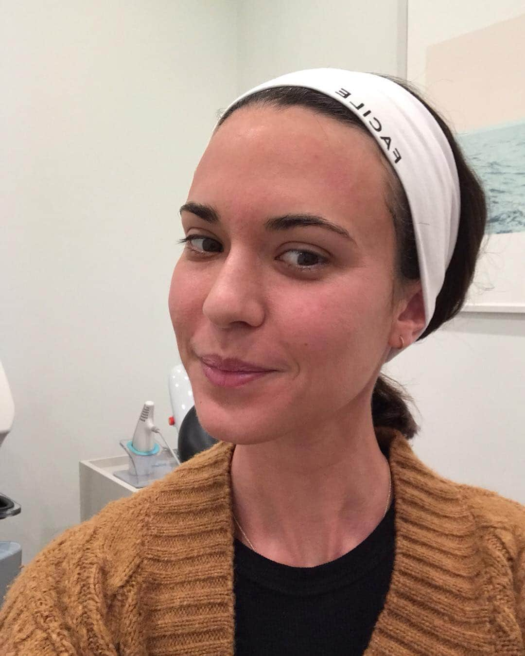 オデット・アナブルさんのインスタグラム写真 - (オデット・アナブルInstagram)「I’ve always struggled with acne scars and I just got some PRP with microneedling done at my new fav. skin place @facileskin and I heard it’s supposed to work wonders. Here’s before, during, and after without any filters so you can see all the real stuff. Check my stories to see more of the whole process. I’m gonna be glowing (I hope 🤞🏽!!!) Thanks @drsamolitis ❤️」3月22日 9時29分 - odetteannable