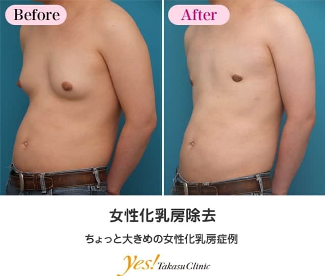 高須クリニックさんのインスタグラム写真 - (高須クリニックInstagram)「⠀ 👨🏻‍⚕️高須幹弥医師からのコメント✨⠀ 30代男性の患者様で、10代の痩せていた頃から乳腺が発達して胸が大きめだったらしく、最近太ったら更に大きくなってきたそうです。 手術は、脂肪吸引で乳腺周囲の脂肪を除去し、乳輪の下半分を切開して乳腺除去をしました。 術後は男性的な平らな胸になりました。 この程度の膨らみの女性化乳房なら、術後に皮膚のたるみはほとんど生じません。 ----------------------------------------------------⠀ 🌈料金✨⠀ ●女性化乳房除去 乳腺除去 ¥400,000~600,000 / 脂肪吸引 ¥380,000~570,000 【東京 、横浜 、名古屋 、大阪 】 ※脂肪吸引は取る脂肪の量によって料金が変わります。詳しくは診察時にご確認ください。⠀ ----------------------------------------------------⠀ ⚠️リスク・副作用・合併症✨⠀ ●女性化乳房除去 手術後に処方する抗生剤や痛みどめによるアレルギー症状 仕上がりのわずかな左右差（完璧なシンメトリーは不可） 傷跡が肥厚性瘢痕やケロイドになる可能性 手術後の血腫 元の胸が大きいと、乳輪の傷跡の治るのに時間がかかる ----------------------------------------------------⠀ 😊施術についての詳細✨⠀ https://www.takasu.co.jp/photo/gynecomastia_pic14.html ----------------------------------------------------⠀ 📞ご予約・お問い合わせ✨⠀ 0120-5587-10⠀ https://www.takasu.co.jp/cgi-bin/form/contact.cgi⠀ ----------------------------------------------------⠀ #30代 #男性 #乳腺 #乳腺除去 #男性のバスト #胸の膨らみ #乳腺の発達 #乳腺発達 #皮膚 #美容 #美肌 #アンチエイジング #美容整形 #美容外科 #美容クリニック #美容好き #美容皮膚科 #モニター #モニター募集 #高須クリニック #高須クリニック名古屋 #高須幹弥 #整形したい #プチ整形 #症例 #症例写真 #可愛くなりたい #可愛い #美人」3月22日 20時11分 - takasu_staff