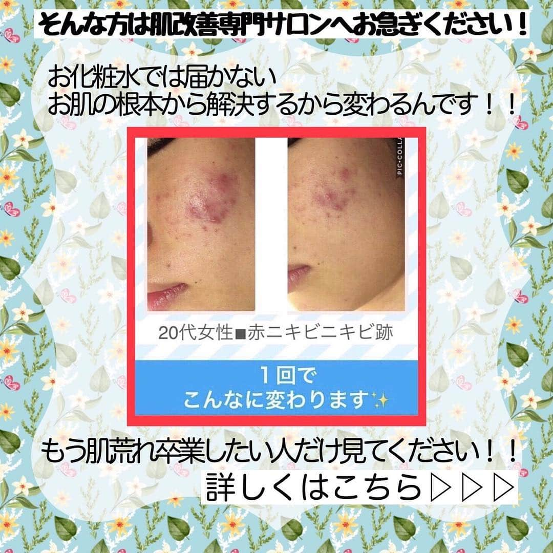 肌質改善専門サロン~Accueil~さんのインスタグラム写真 - (肌質改善専門サロン~Accueil~Instagram)「💙💚💛23,24日空きあり💛💜❤ * * 【ご予約はこちら👇🏼】 🌟🌟 @accueil_ikebukuro 🌟🌟 . ※今だけ期間限定クーポンあり . . . 肌荒れの原因は人それぞれなのにも関わらず、 周りの人と同じケアをしていませんか💦？？ * ❌お薬を塗っても飲んでも変わらない、、 ❌食事を気にしても肌が荒れる、、 ❌スキンケアを変えてもイマイチ、、 ❌何かしら常にトラブルが肌にある、、 ❌ニキビが繰り返しできる、、 * * そのお悩み解決できちゃいます😌✨ Accueilは、どのサロンに行っても良くならなかったお客さまたちや、 どの皮膚科に行っても変化がなかったお客さまたちが多く訪れてくださっています🙌💕* * * * もう悩まない！！！ 繰り返さないところまでしっかりと根本改善していきます☺️ そろそろ肌荒れから卒業しませんか？ * →→→初回体験はこちらから👉🏼 @accueil_ikebukuro * * * * Accueilでのお手当は、、 * 機械は一切使いません🙅‍♀️❌ 使うお化粧品は １００％天然の「ミネルヴァ化粧品」🌲🍃 ニキビの炎症がある方・アトピーの方でも 安心して受けていただける事ができる お肌にとても優しいエステです♡♡ * * お肌のお悩みなら、何でもお任せください😊💕 * * ■「インスタ見ました！」 で、 初回体験￥26,000 →→✨￥５，９８０✨ * * * --------当サロンのご予約方法≫--------- *  1️⃣当サロンのインスタTopのURL ⭐『Hotpepper Beauty』の 「instagram限定クーポン」にてご予約可能♡♡ * * 2️⃣インスタのDMからご予約 （下記項目を記載の上、お問い合わせください♪） * 🔶お名前（フルネーム） * 🔶お電話番号 * 🔶希望日時（第１～第３希望） * 🔶ご希望のメニュー * * 3️⃣お電話でのご予約✨ 　03-6912-5705にお願いします♡ ----------------------------------------- * * @accueil_ikebukuro ✨ #ニキビ #ニキビ跡 #毛穴 #乾燥肌 #ニキビ跡ケア #肌荒れ #ニキビ跡改善 #ニキビ肌改善 #ニキビ治療 #保湿 #毛穴の黒ずみ #毛穴の開き #スキンケア #毛穴吸引 #アトピー女子 #ニキビ皮膚科  #美肌ケア  #ニキビ専門 #肌質改善 #背中ニキビ #アトピー肌 #乾燥 #ニキビケア #毛穴ケア #アトピー治療 #肌悩み #スキンケア難民 #肌トラブル改善 #スキンケア大事 #目指せ美肌」3月23日 0時06分 - accueil_ikebukuro