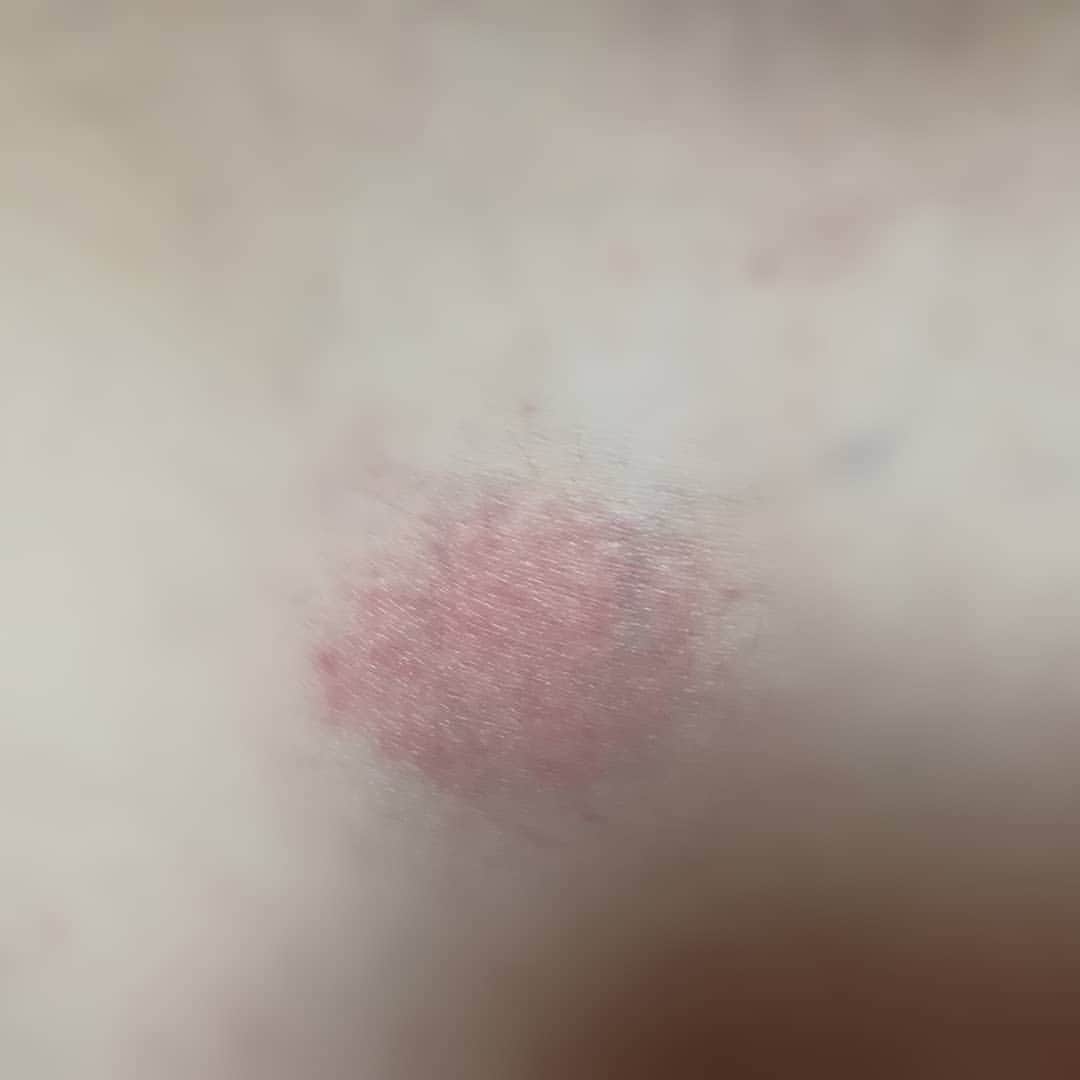 千種ゆり子さんのインスタグラム写真 - (千種ゆり子Instagram)「【3/25千種ゆり子の空てんき】 帯状疱疹になりました。昨昼から痛みが出始め、夜には五百円玉の赤い丸い発疹が。 . 今朝には色が薄くなってたけど、今でも若干チクチク、ズキズキする。 . 楽しみにしてた勉強会は泣く泣く欠席。 . 今週は桜を優先させるために、体調を整えるしかないか。。 . 家で何してゆっくり過ごしたらいいかわからない。誰かゆっくり過ごすときに「食べる」以外に何したらいいか教えてください😭 . 二枚目は井の頭公園のソメイヨシノ♥️だいすき♥️ . #桜 #ソメイヨシノ #井の頭公園 #さくら #サクラ #帯状疱疹」3月25日 12時27分 - chikusa_yuriko