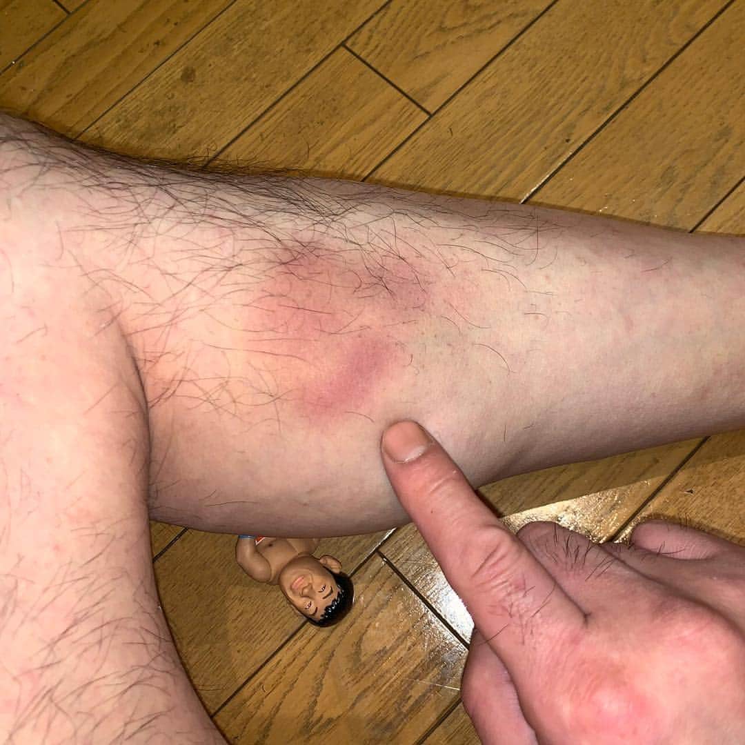 のインスタグラム：「. 【Bruise】 . たぶん、デラヒーバフットロックのかけすぎでアザができてしまいました😅 . #sakuraba #デラヒーバフットロック #BJJ #QUINTET」