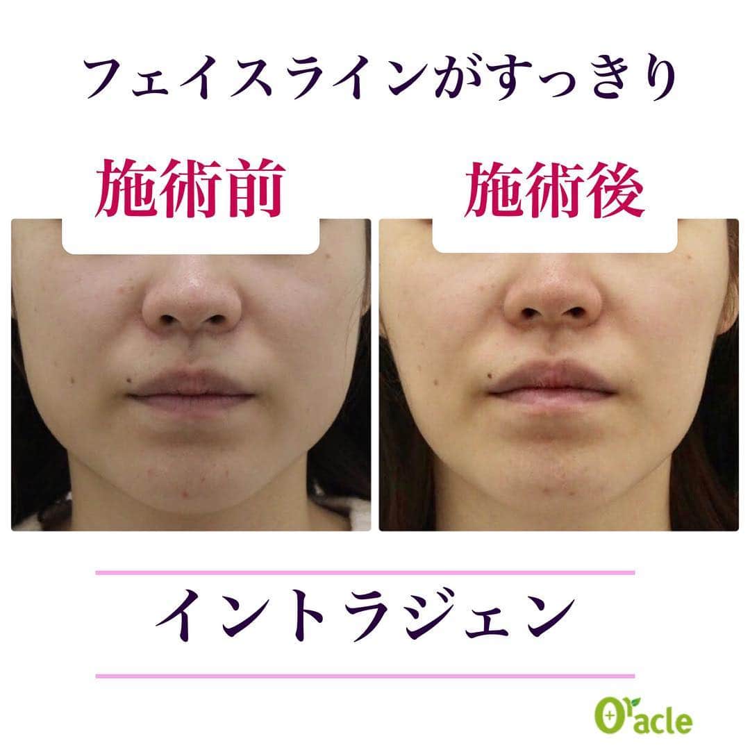 オラクル美容皮膚科東京新宿院さんのインスタグラム写真 - (オラクル美容皮膚科東京新宿院Instagram)「【たるみ改善スペシャルコンビ】 実はオラクルのドクターやスタッフのリピート率が高いのが『イントラジェン』 艶、ハリがでます❣️ . そして… 3月中のご予約で、水光初のたるみ成分で人気の『ティツィアーノ水光注射』と リフトアップと美肌が叶う 『イントラジェン400』がセットでお得になってます‼️ かなりお得です‼️ . なんと‼️ ティツィアーノ水光注射＋イントラ400 💎通常 146,000円 → 90,000円（税抜） . 単品ですと 💎ティツィアーノ水光注射 50,000円 💎イントラ400  96,000円 . . ✨イントラジェンの２つの効果✨ . ★即効性⇨引き締め効果 皮膚の真皮にラジオ波を照射すると、 熱でコラーゲン線維が収縮し たるんだ皮膚が引き締まります⭐️ . ★持続性⇨ハリ・リフトアップ効果 収縮したコラーゲン線維が修復する過程で 新しいコラーゲンが再構築されるため 肌のハリやリフトアップ効果が期待できます‼️ . . ✔︎たるみが気になる ✔︎フェイスラインの崩れが気になる ✔︎ゆるみ毛穴が気になる ✔︎肌のハリや弾力がほしい . . このようなお悩みがある方は 是非お試しください🙆‍♀️ どの年代にもおすすめの施術です😇 . . 👇ご予約はこちら👇 . ☆・‥…━━━☆・‥…━━━☆ ・ 【オラクル美容皮膚科】 フリーダイヤル 📞0120-905-696 コールセンター 受付時間 9:00～21:00［年中無休］ LINEからもご予約可能です ID：@oracle.jp ・ ☆・‥…━━━☆・‥…━━━☆ ・ #オラクル美容皮膚科 #オラクル #美容皮膚科 #韓流美肌 #ハイフ #hifu #オルチャン #たるみ #しわ #ウルセラ #イントラジェン #アンチエイジング #美魔女  #ハリ #若返り #コラーゲン  #リフトアップ #韓国美容 #얼짱 #オルチャン #美容女子 #피부관리 #미백 #미백관리」3月25日 19時57分 - oraclejp