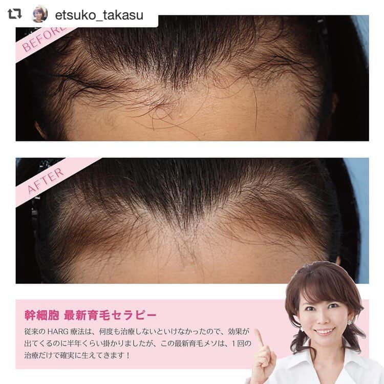 高須クリニック名古屋院さんのインスタグラム写真 - (高須クリニック名古屋院Instagram)「#repost @etsuko_takasu via @PhotoAroundApp  女性は更年期を過ぎたあたりから、女性ホルモンが減少していくので、女性の薄毛でお悩みの方はとても多いですが、従来のHARG療法より1回の治療効果がかなり高い、最新育毛治療をご紹介します。50代女性です。前髪の薄毛で、ボリュームが出ずにペチャンとなってしまう事がお悩みでした。 生え際に注射したところだけ、フサフサ生えてきました！ 1回メソセラピー注射しただけで、この効果です！！ ・ 今までのHARG療法は、何度も治療しないといけなかったので、効果が出てくるのに、半年くらい待っていましたが、この新しい育毛メソは、1回の治療だけで、確実に生えています！ 髪が伸びるスピードがあるので、その期間はお待ち頂きますが、1回だけで効果が出たことは、患者さまのご負担もかなり楽になりました♫ （注射は、麻酔のクリームを塗ってから行いますので、痛みは軽減されます） ・ 基本的には、メソセラピー注射した範囲だけ髪が生えてきますので、注射していない部分は生えてきませんので、ご了承ください。 ・ 【料金】 ●幹細胞 新育毛メソセラピー ハガキ1枚分の範囲：400,000円（税別） ※料金は2019年3月8日現在 ※保険適用外、自由診療 ・ 【副作用・リスク】 ●注射による内出血 ●アレルギー（麻酔、薬剤） ・ 【ご予約・お問い合わせ】 名古屋院☎︎ 052-564-1187 栄院☎︎ 052-971-6650 名古屋院📱 @takasuclinic_nagoya 栄院📱 @takasuclinic_sakae ↑両院インスタのプロフィール画面からも直接コンタクトが取れます📲 https://www.takasu.co.jp/ ・ ・ #高須クリニック #高須クリニック名古屋院 #高須幹弥 #高須英津子 #美容整形 #整形 #二重 #埋没法 #二重切開 #ヒアルロン酸 #鼻 #ニキビ #薄毛治療 #たるみ #眼瞼下垂 #シワ #整形したい #美容好きな人と繋がりたい #可愛くなりたい #綺麗になりたい #プチ整形 #二重整形 #目尻切開 #目頭切開 #ビフォーアフター」3月26日 18時25分 - takasuclinic_nagoya