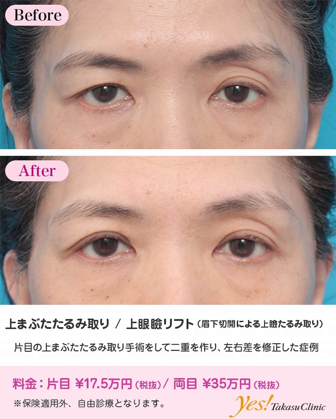 高須クリニックさんのインスタグラム写真 - (高須クリニックInstagram)「⠀ 👨🏻‍⚕️高須幹弥医師からのコメント✨⠀ 50代女性の患者様で、左目は二重なのに、右目は皮膚のたるみが多く奥二重になっているので、右目を手術して左目に合わせたいという御要望でした。 じっくり診察すると、左目は老人性の眼瞼下垂が進行して、まぶたの開きが悪くなっており、それに加えてまぶたの脂肪の萎縮により、まぶたが窪んで二重になっていました。 右目も軽度の眼瞼下垂を呈しており、それに加えてまぶたの皮膚のたるみもありました。 この方は、両目の眼瞼下垂手術を行い、まぶたの開きを良くして、二重を作り直し、必要に応じて左目の窪みにヒアルロン酸を注射すれば、ほぼ左右対照の目になるので、その治療をご提案しましたが、患者様は、左目はこのままでよく、右目を左目に合わせるだけでいいということだったので、右目の上まぶたたるみ取りのみをすることになりました。 手術は皮膚を約4mmの幅で切除し、目を閉じた状態で約7mmの位置に二重のラインを作りました。 術後は二重の幅はほぼ左右対照になりましたが、左目の窪みが強いため、完全な対照の目にはなっていません。 手術のときに、右目の脂肪をごっそりと取って、目を窪ませてしまえば、左右対照になりますが、窪んだ目は老けた印象や窶れた印象を与えるし、いつか眼瞼下垂手術をする可能性があることも考慮して、脂肪は取りませんでした。 ----------------------------------------------------⠀ 🌈料金✨⠀ ●上まぶたたるみ取り 片目 ¥175,000 / 両目 ¥350,000 【東京 、横浜 、名古屋 、大阪 】 ----------------------------------------------------⠀ ⚠️リスク・副作用・合併症✨⠀ ●上まぶたたるみ取り 内出血（術後） 仕上がりの左右差（片目ずつ手術をする場合） 仕上がりのわずかな左右差（完璧なシンメトリーは不可） 仕上がりが完璧に自分の理想の形にならないことがある 二重のラインの癒着がとれる可能性 手術後の血腫⠀ ---------------------------------------------------⠀ 😊施術についての詳細✨⠀ https://www.takasu.co.jp/photo/tarumi23.html ----------------------------------------------------⠀ 📞ご予約・お問い合わせ✨⠀ 0120-5587-10⠀ https://www.takasu.co.jp/cgi-bin/form/contact.cgi⠀ ----------------------------------------------------⠀ #まぶたのたるみ #まぶたの脂肪 #奥二重 #眼瞼下垂 #まぶたのたるみ取り #まぶたのたるみを取りたい #二重まぶた #二重 #皮膚 #美容 #美肌 #アンチエイジング #美容整形 #美容外科 #美容クリニック #美容好き #美容皮膚科 #モニター #モニター募集  #高須クリニック #高須クリニック名古屋 #高須幹弥 #整形したい #プチ整形 #症例 #症例写真 #可愛くなりたい #可愛い #美人」3月26日 17時07分 - takasu_staff