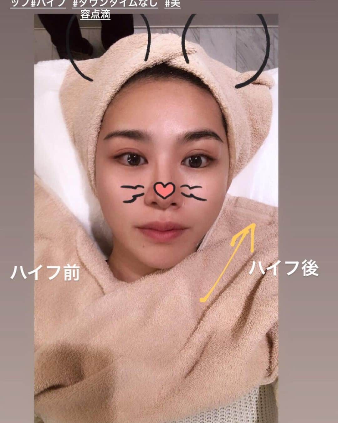 南美沙さんのインスタグラム写真 - (南美沙Instagram)「@christinaginza  で、ハイフしてもらってきましたー😆✨. 1枚目が3日たった今✨. 自分的にはめっちゃいい感じ✨. 2枚目の左右差もすごくないですか？？✨. ここの機械は、今一番新しい機械らしく、、昔のから大分進化してるから全然痛くないし、嘘みたいにリフトアップした🤭✨. やっぱり、機械の新しさ大事ですよね✨. 切ったり、糸とかのリフトアップは怖いから、ダウンタイムも無しだし健全な美容法😉✨. . 直後にも効果が感じられるのに、2、3ヶ月後にはもっと効果が感じられるみたい🥰✨. 来月楽しみな撮影あるから、やってよかった！❤︎. . 更に、ハイフやってもらってる間に美容点滴も打ってもらって、、体調もお肌の感じも良いし、時短美容が出来て至れり尽くせりでした☺️✨✨🙏. 美容点滴は沢山種類があるから、悩みに合わせてセレクトしてくれるよ❤️. そして、引き締め効果抜群のVLS注射も✨. ハイフのリフトアップと相乗効果で引き締まった輪郭になるんだって☺️❤️❤️ . 先生も、カウンセラーの方も優しくて親切で親身に悩みを聞いてくれるから、ここのクリニック大好きになりましたー🥰✨✨. . . #クリスティーナクリニック#christinaginza#小顔#リフトアップ#ハイフ #ダウンタイムなし #美容点滴 #小顔注射」3月27日 19時16分 - miee.misa