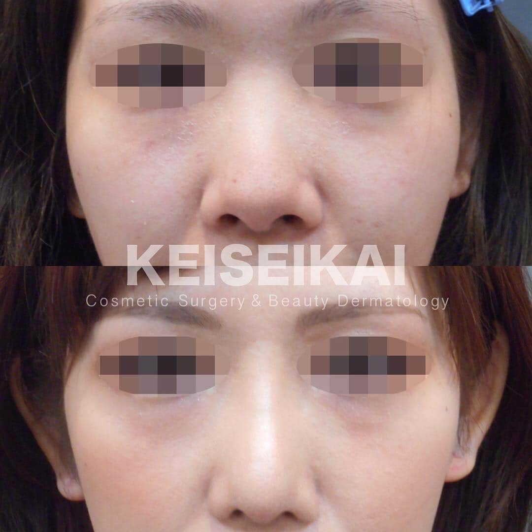 恵聖会クリニックさんのインスタグラム写真 - (恵聖会クリニックInstagram)「⠀ ＼美鼻モニター様／ ⠀ ▫️以前他院で小鼻縮小をしたけどもう少し小さくしたい ▫️鼻のバランスを整えたい ▫️鼻先をスッキリさせて高さを出したい と希望され ・鼻プロテーゼ ・鼻尖形成 ・耳介軟骨移植による鼻中隔延長 ・小鼻縮小 中間法 を受けられました。 ⠀ 1枚目→左：施術前  右：施術3ヶ月後 2,3枚目→上：施術前  下：施術3ヶ月後 ⠀ 他院で受けられた手術の修正も行っておりますので、お気軽にご相談ください。 ⠀ 💴鼻プロテーゼ：150,000円 💴鼻尖形成：250,000円 💴耳介軟骨による鼻中隔延長：300,000円 💴小鼻縮小 中間法：180,000円 🈹4施術同時割引：10%OFF 計792,000円 ※税抜表示 ⠀ ⚠️リスク：腫れ・浮腫・内出血・感染症・血腫 ⠀ #美鼻 #鼻整形 #プロテーゼ #鼻プロテーゼ #隆鼻術 #鼻を高く #鼻を高くしたい #鼻尖形成 #小鼻縮小 #鼻翼縮小 #鼻中隔延長 #団子鼻 #だんご鼻 #整形 #美容整形 #ビフォーアフター #症例写真 #恵聖モニター #モニター募集 #モニター募集中 #恵聖会クリニック #美容外科 #美容クリニック #大阪 #心斎橋 #京橋」3月29日 18時08分 - keiseikai